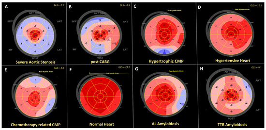 Apical Sparing in Routine Echocardiography: Occurrence and Clinical ...