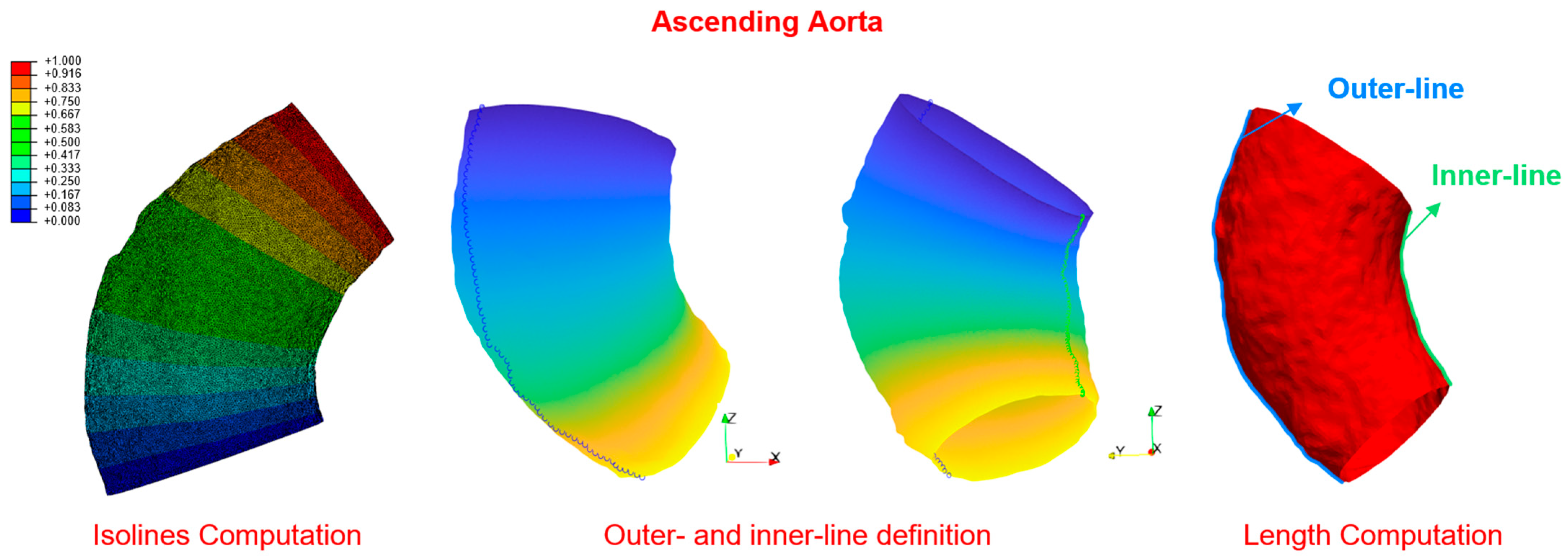 Assessment of the Aorto-Septal Angle Post-Thoracic