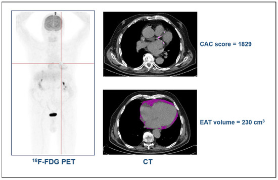 Association of Cardiovascular Risk Factors and Coronary Calcium Burden ...