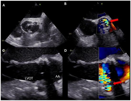 Intraoperative Transesophageal Echocardiographic Guidance in