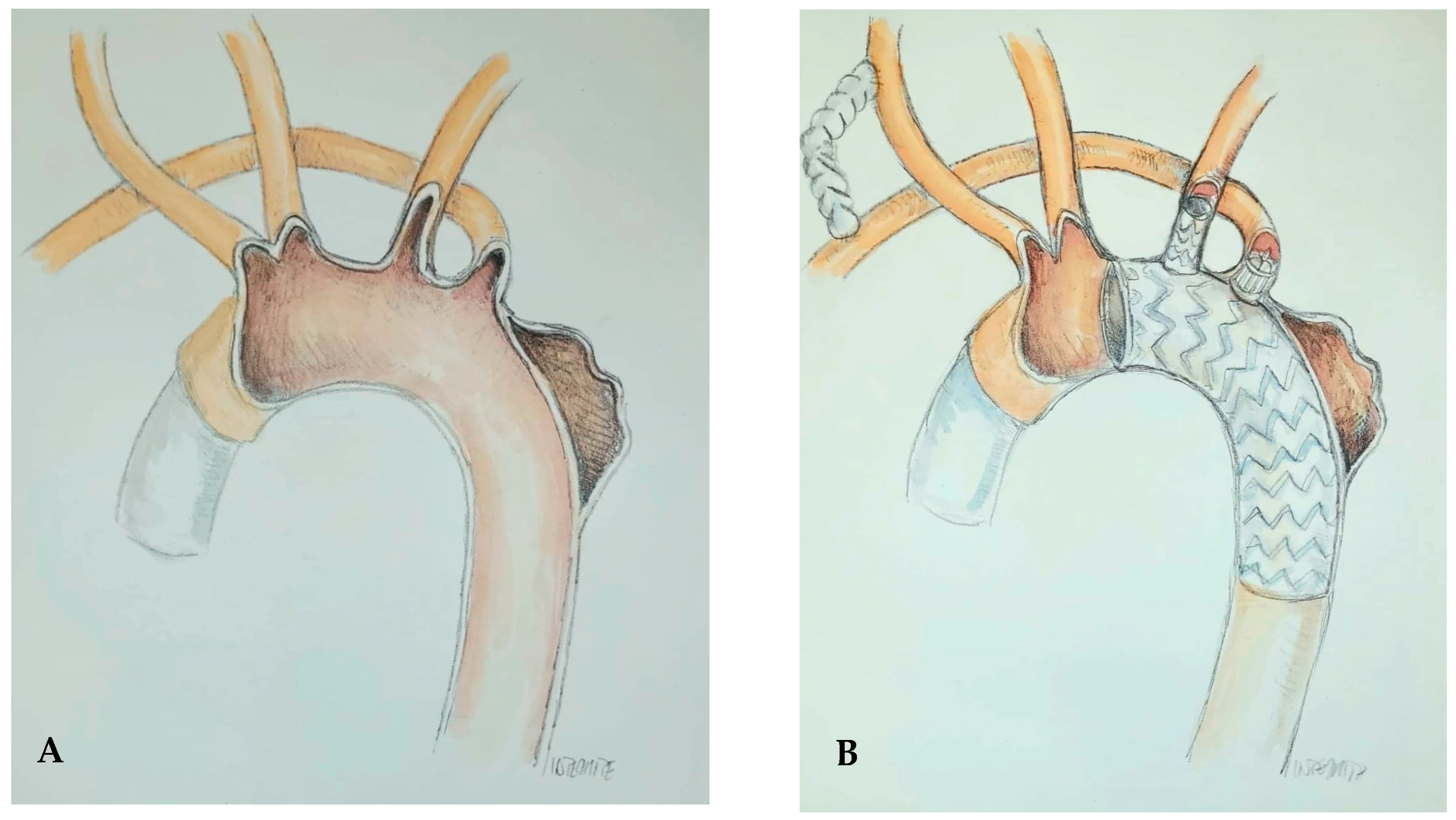 A Clinical Case of Aneurysmal Dilatation of the Aortic Arch