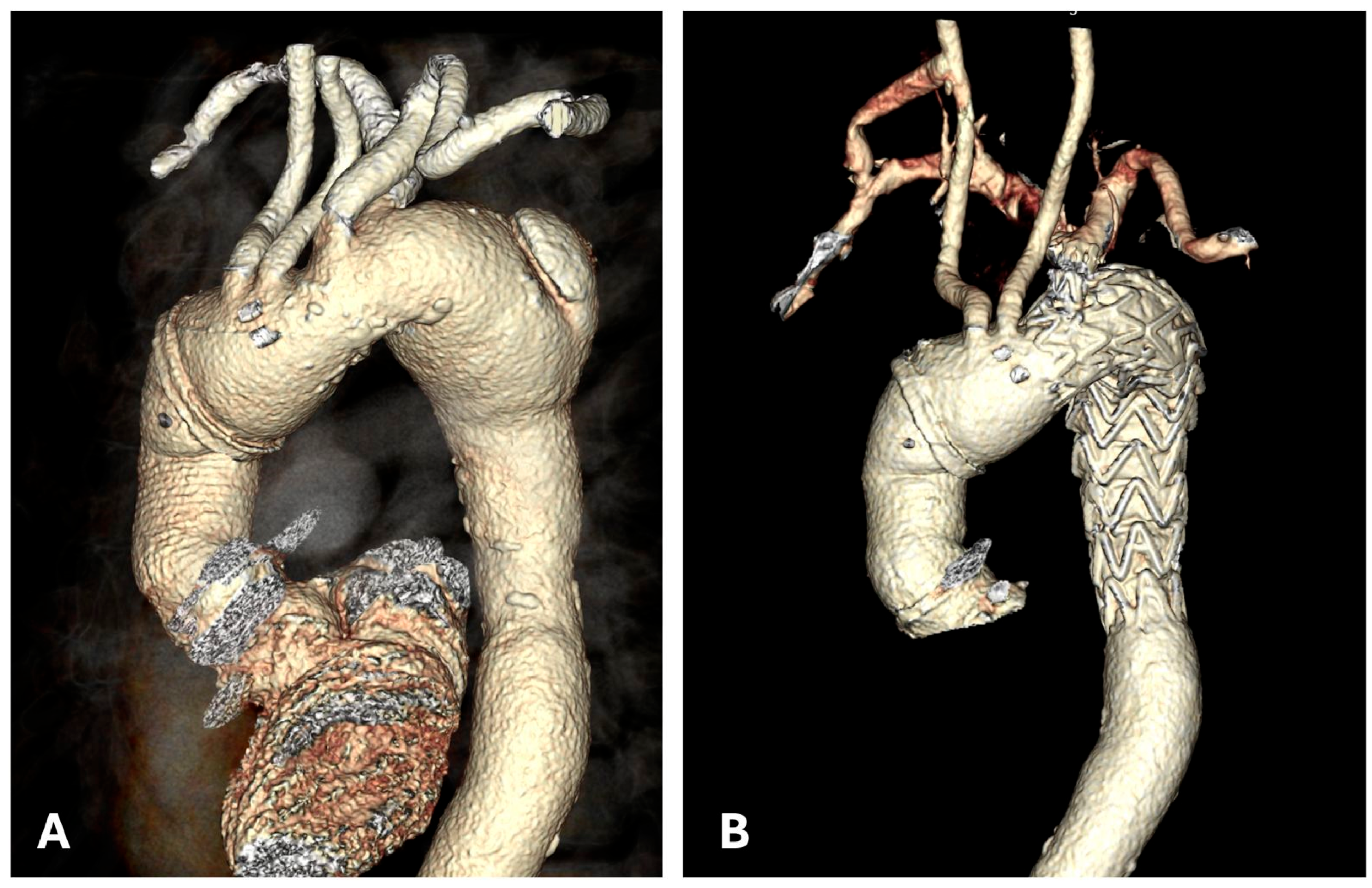 A Clinical Case of Aneurysmal Dilatation of the Aortic Arch