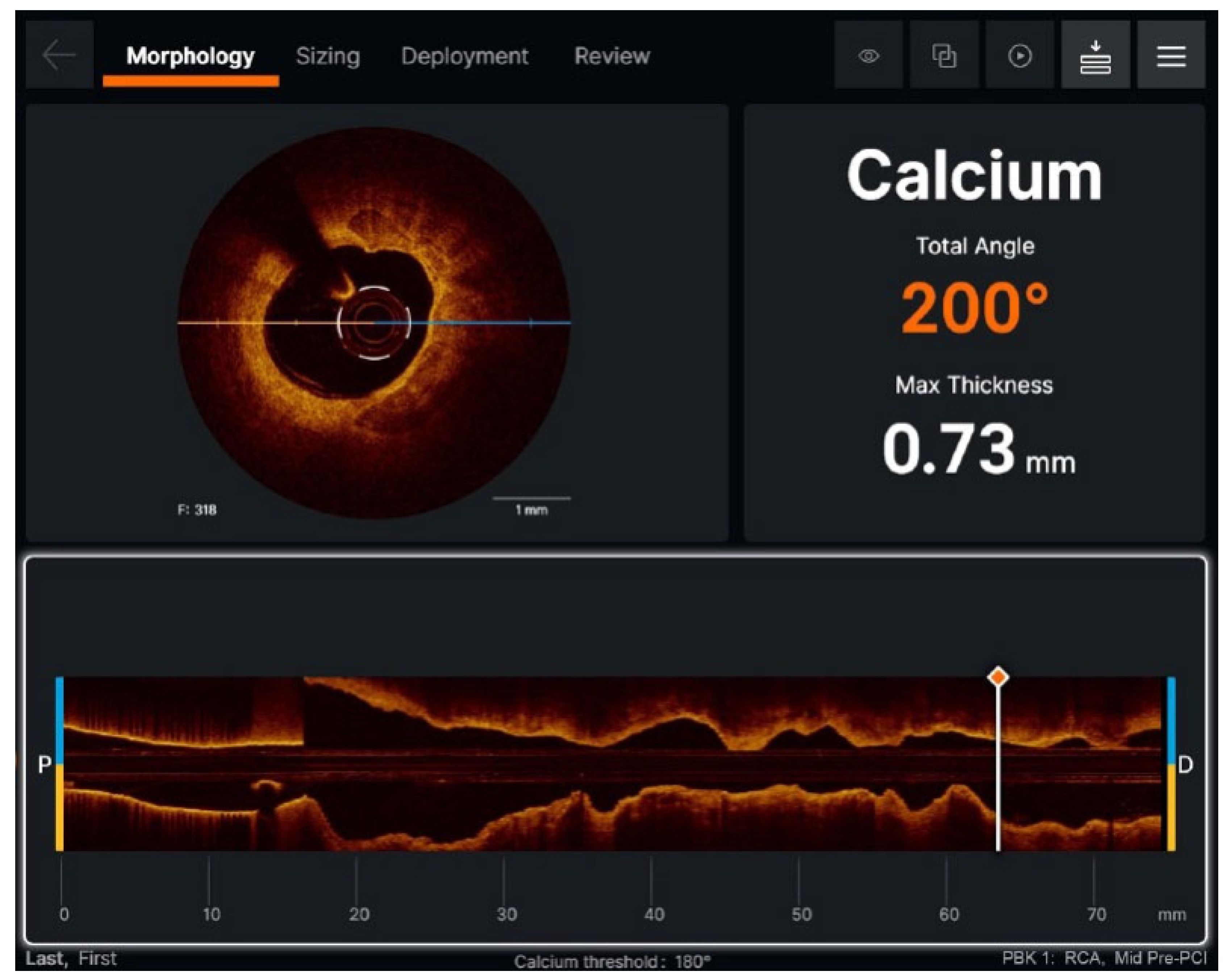 Advances in the Diagnosis and Management of High-Risk Cardiovascular  Conditions: Biomarkers, Intracoronary Imaging, Artificial Intelligence, and  Novel Anticoagulants