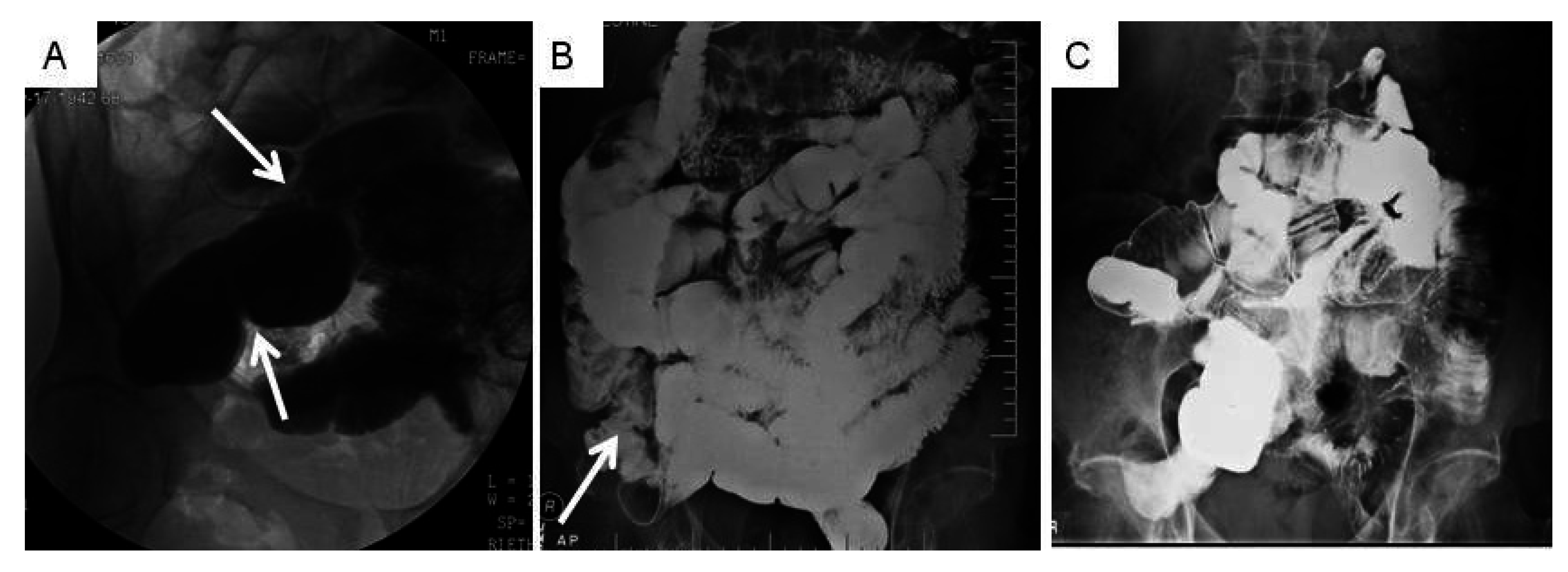 PDF) Development of a Web-Based Nonoperative Small Bowel Obstruction  Treatment Pathway App