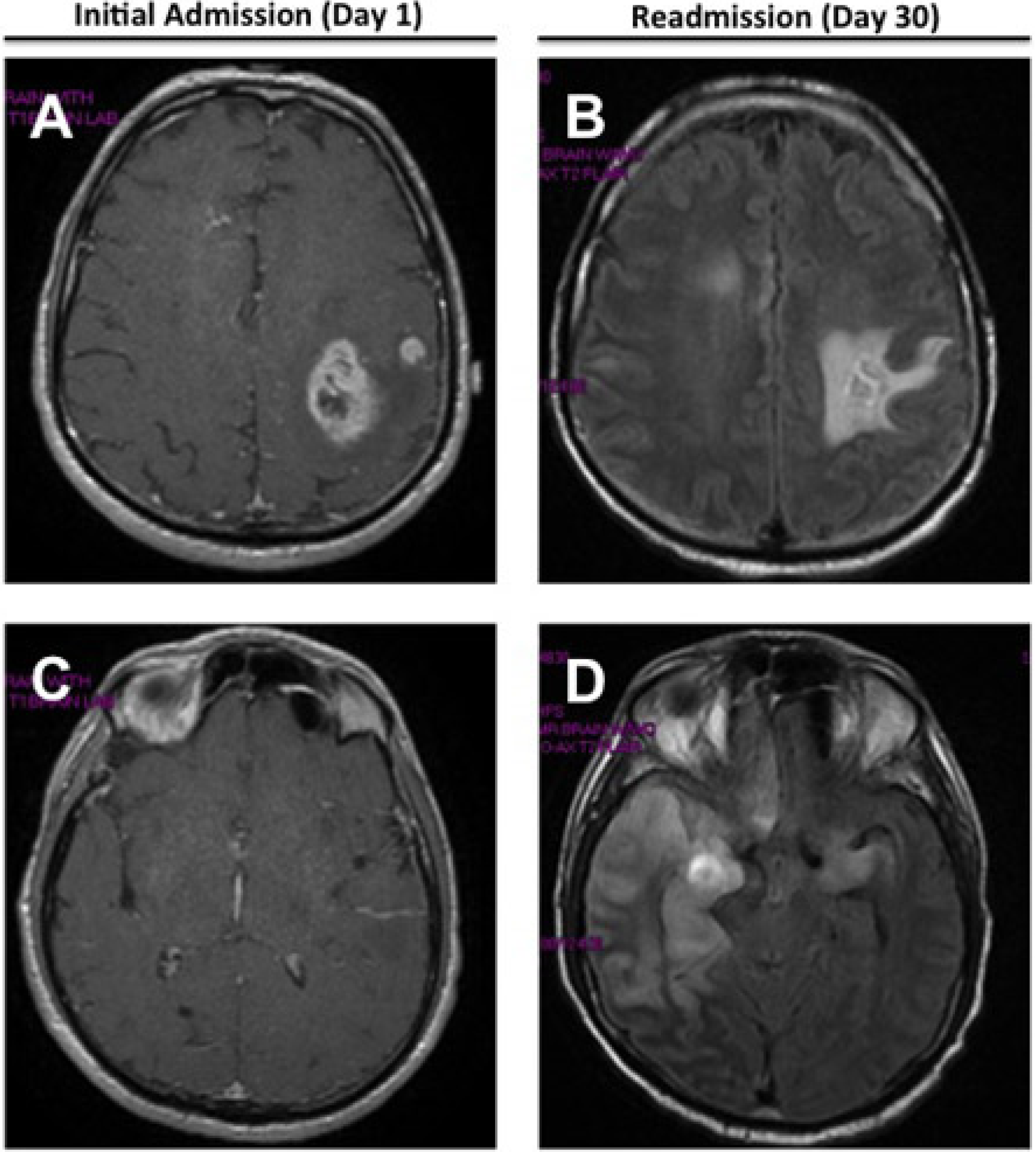 jcm free full text herpes simplex virus hsv 1 ct scan of brain