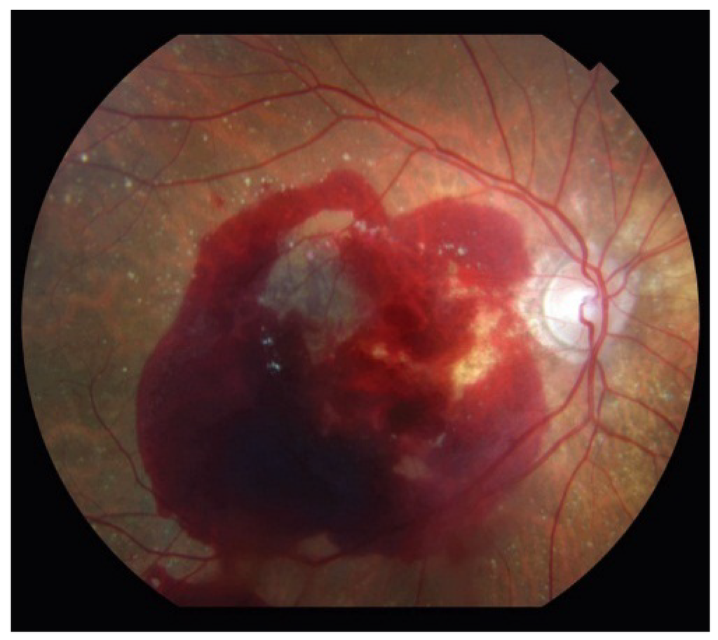 JCM Free FullText AgeRelated Macular Degeneration Advances in