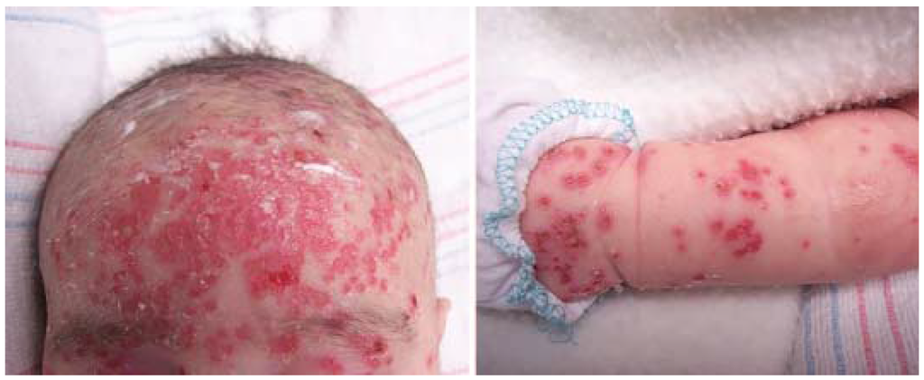 Jcm Free Full Text Diagnosis Of Atopic Dermatitis Mimics Overlaps And Complications Html