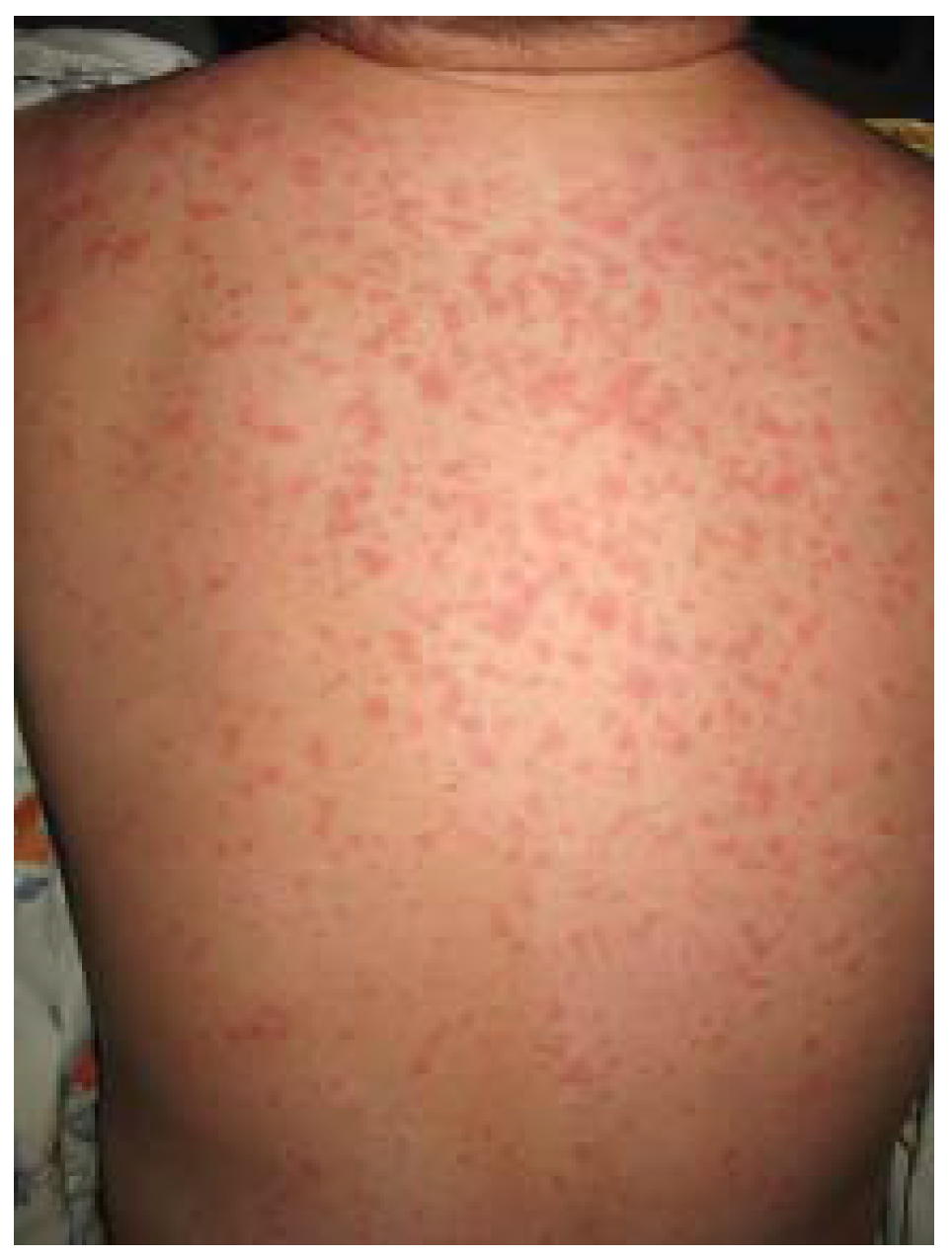 Jcm Free Full Text Diagnosis Of Atopic Dermatitis Mimics Overlaps And Complications Html