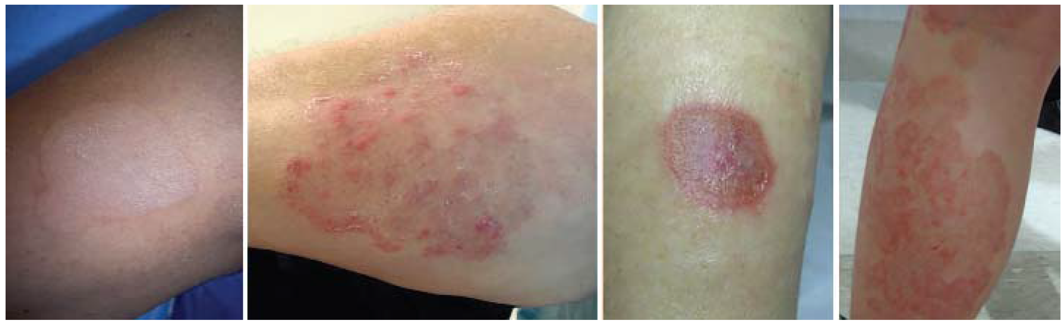 Jcm Free Full Text Diagnosis Of Atopic Dermatitis Mimics Overlaps And Complications Html