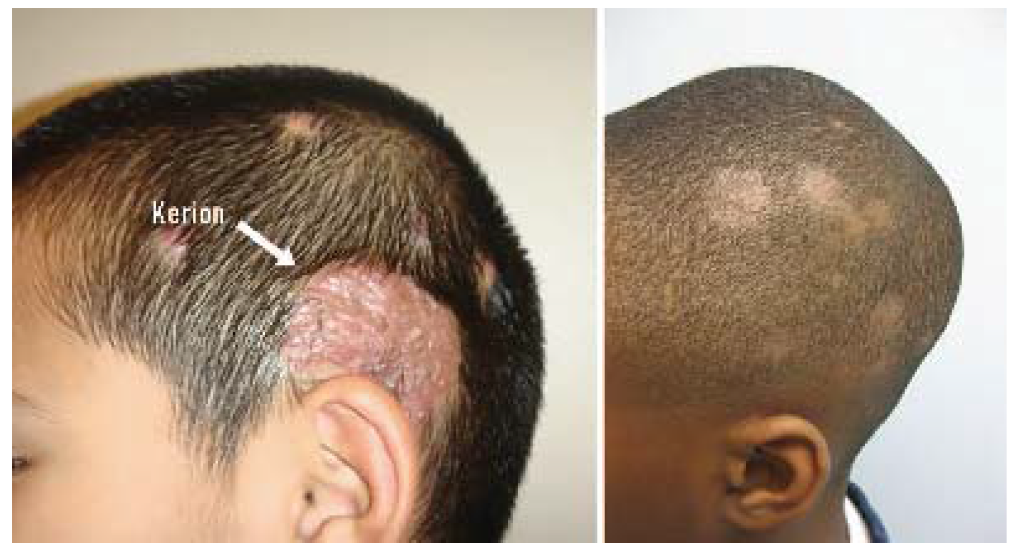 JCM | Free Full-Text | Diagnosis of Atopic Dermatitis: Mimics, Overlaps, and Complications JCM | Free Full-Text | Diagnosis of Atopic Dermatitis: Mimics, Overlaps, and Complications