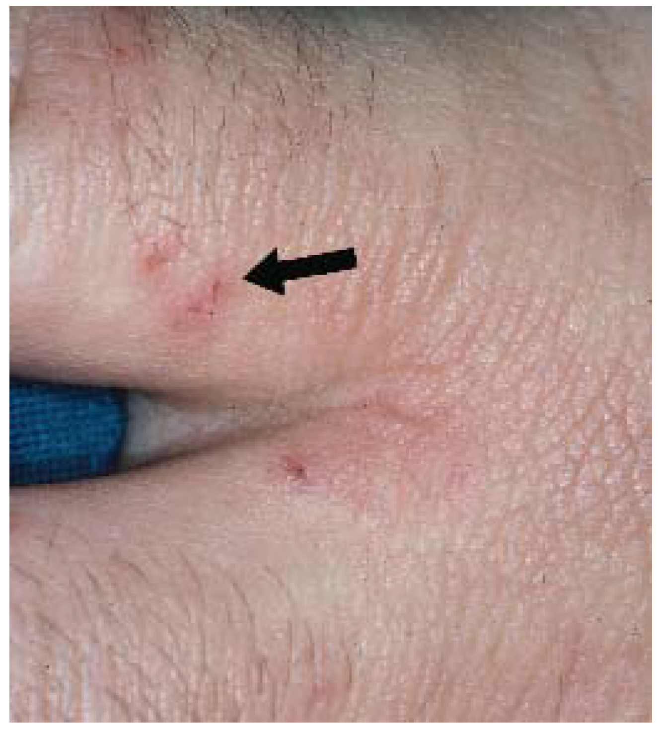 Saint Louis School >> JCM | Free Full-Text | Diagnosis of Atopic Dermatitis ... Saint Louis School >> JCM | Free Full-Text | Diagnosis of Atopic Dermatitis ...