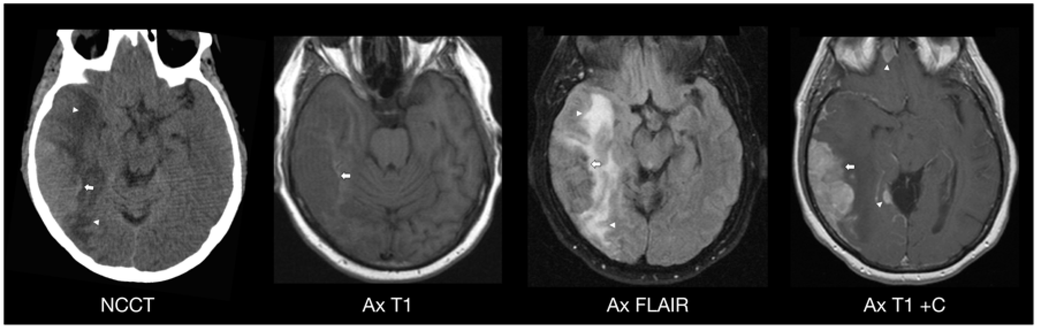 jcm free full text intracranial cns manifestations of children presentation