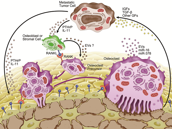 JCM | Free Full-Text | MicroRNAs and Osteolytic Bone Metastasis: The