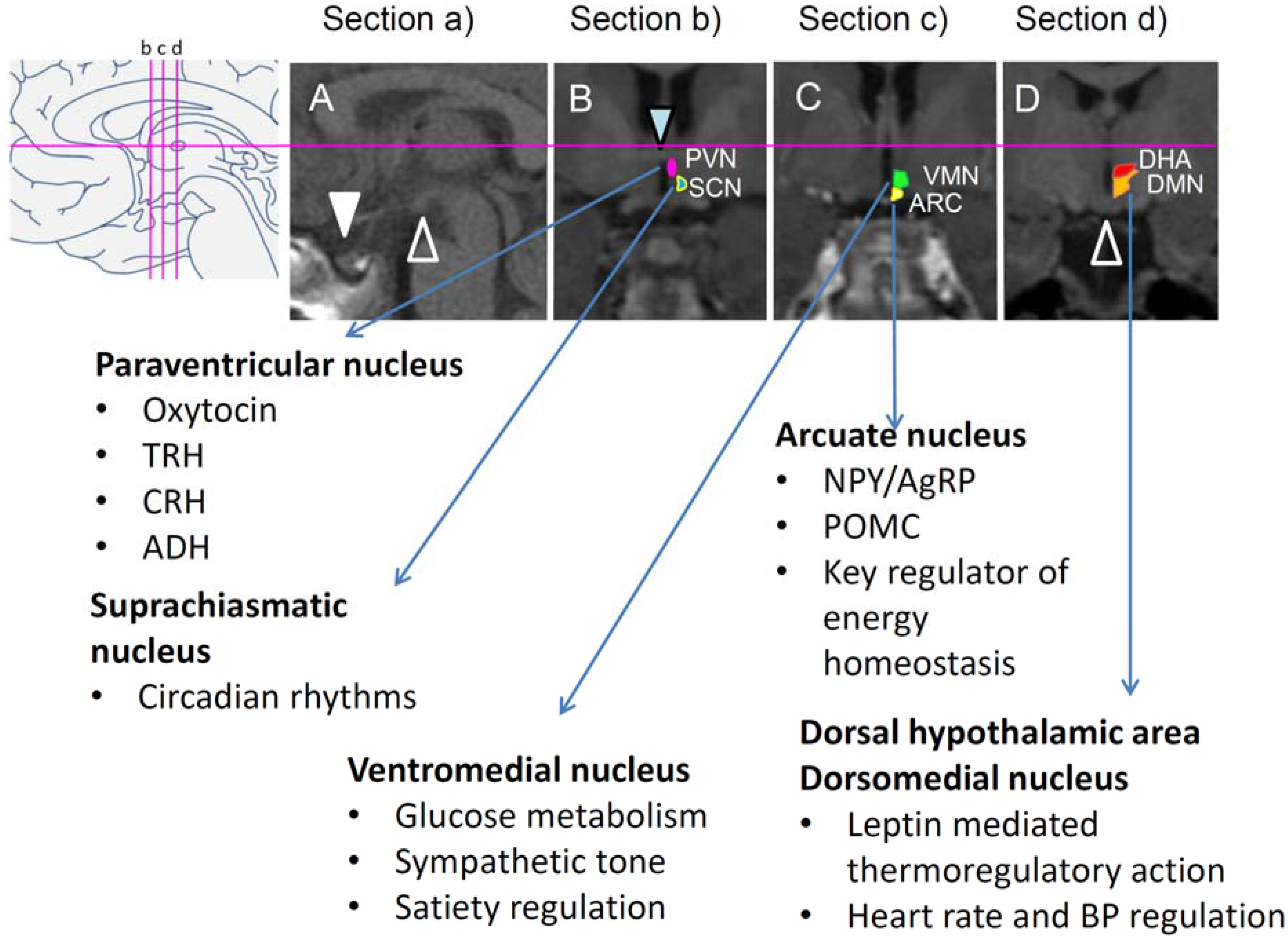 Jcm Free Full Text Hypothalamic Obesity In Craniopharyngioma Patients Disturbed Energy Homeostasis Related To Extent Of Hypothalamic Damage And Its Implication For Obesity Intervention Html