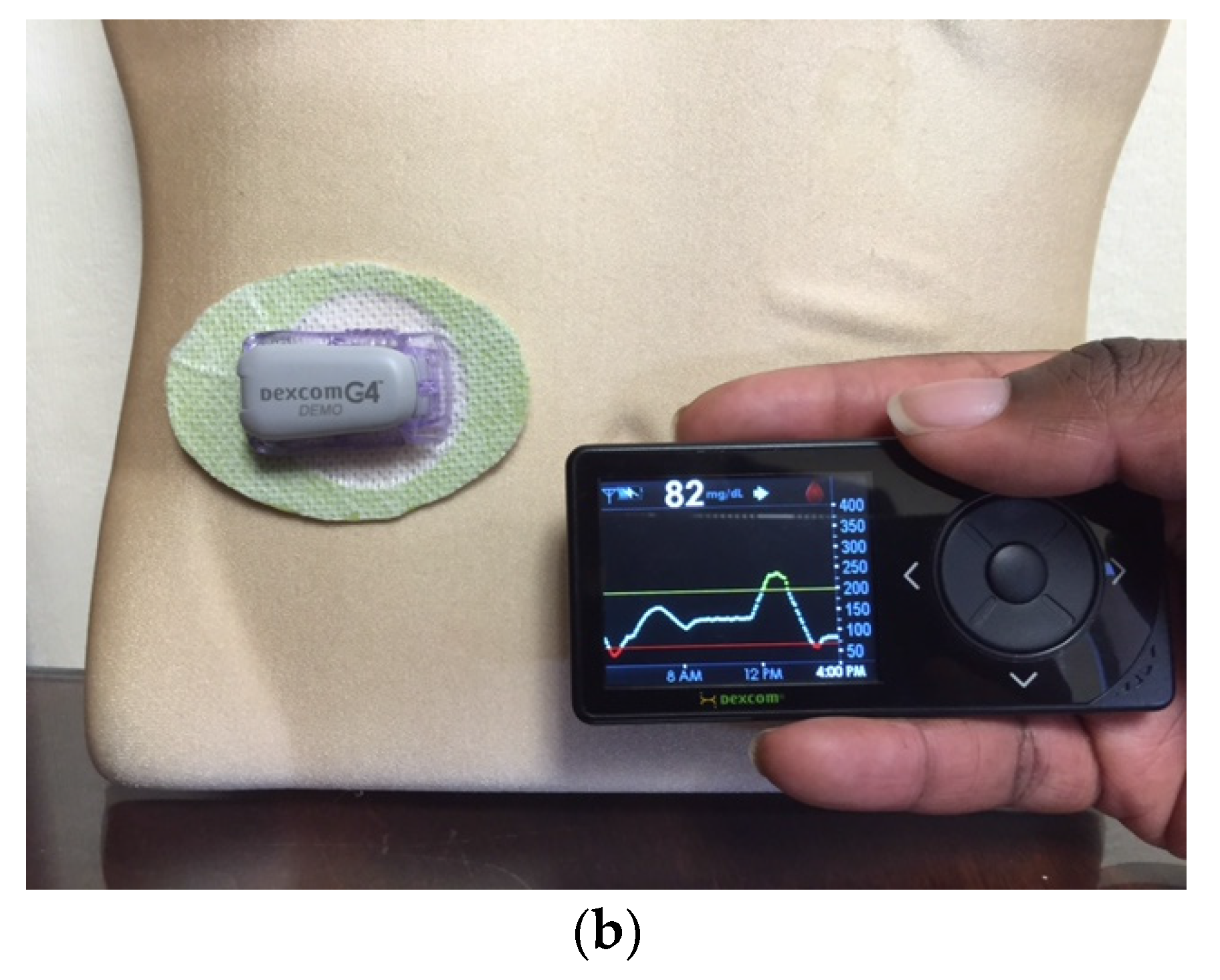 JCM | Free Full-Text | An Overview of Insulin Pumps and Glucose Sensors