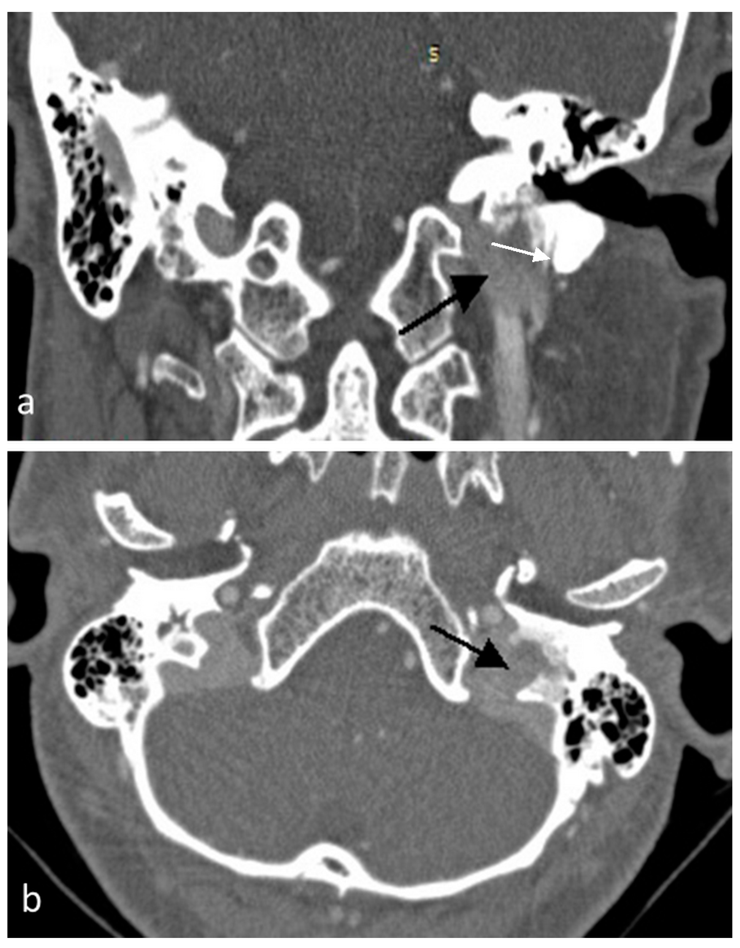 Head / Neck CT Phantom - CTA AVM-Lesion