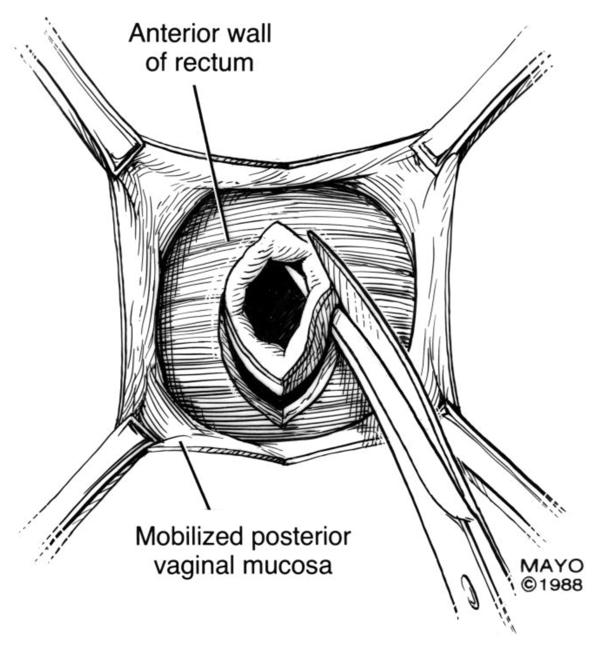 Jcm Free Full Text Colorectal Vaginal Fistulas Imaging And Novel