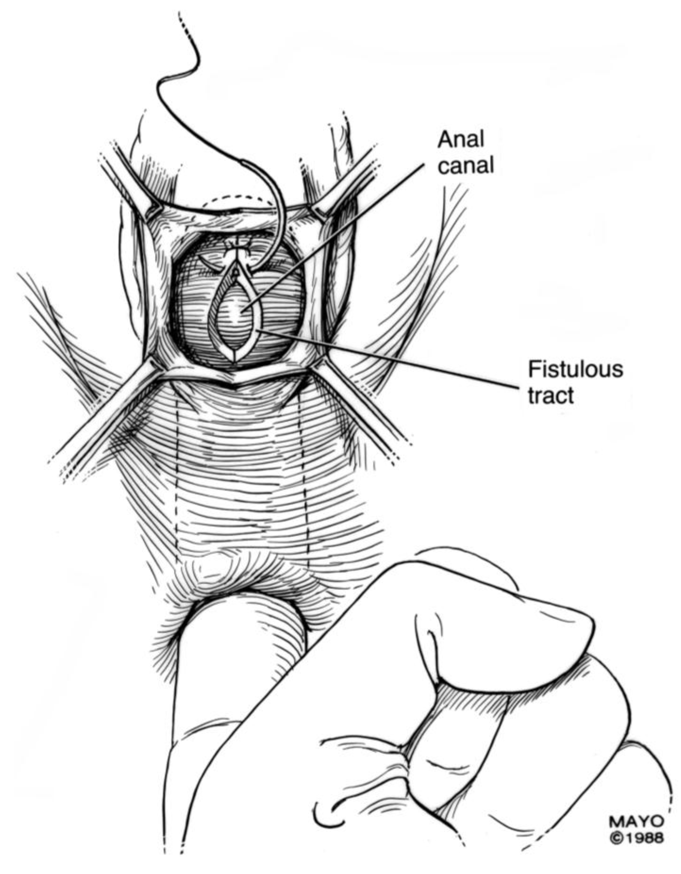 Jcm Free Full Text Colorectal Vaginal Fistulas Imaging And Novel