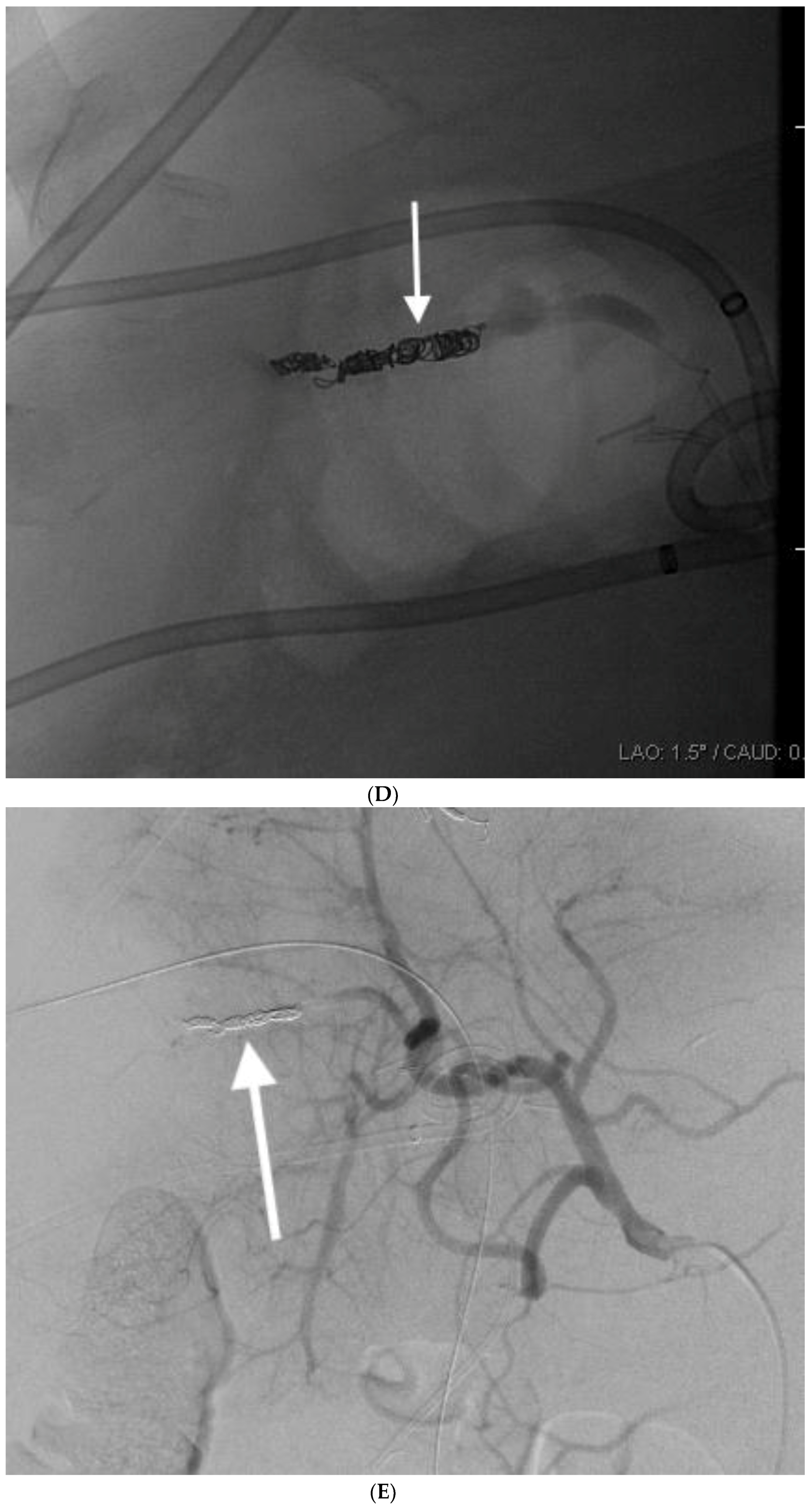 Endoscopic retrograde cholangiopancreatography-guided transpapillary  gallbladder drainage (ERGD): A minimally invasive treatment for acute  cholecystitis - Mayo Clinic