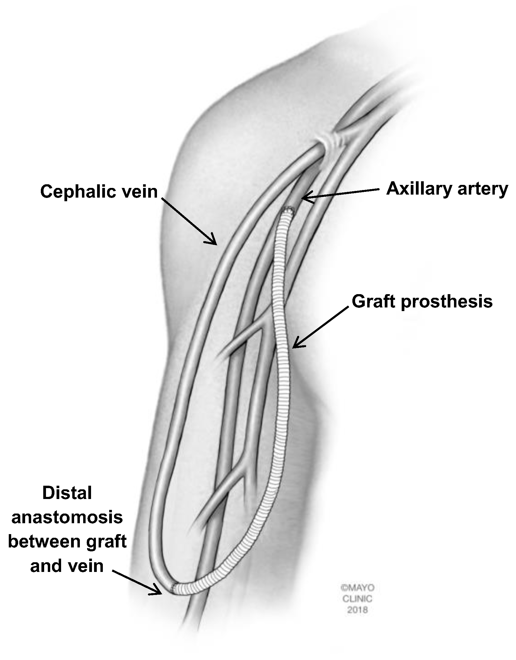 brachial cephalic fistula