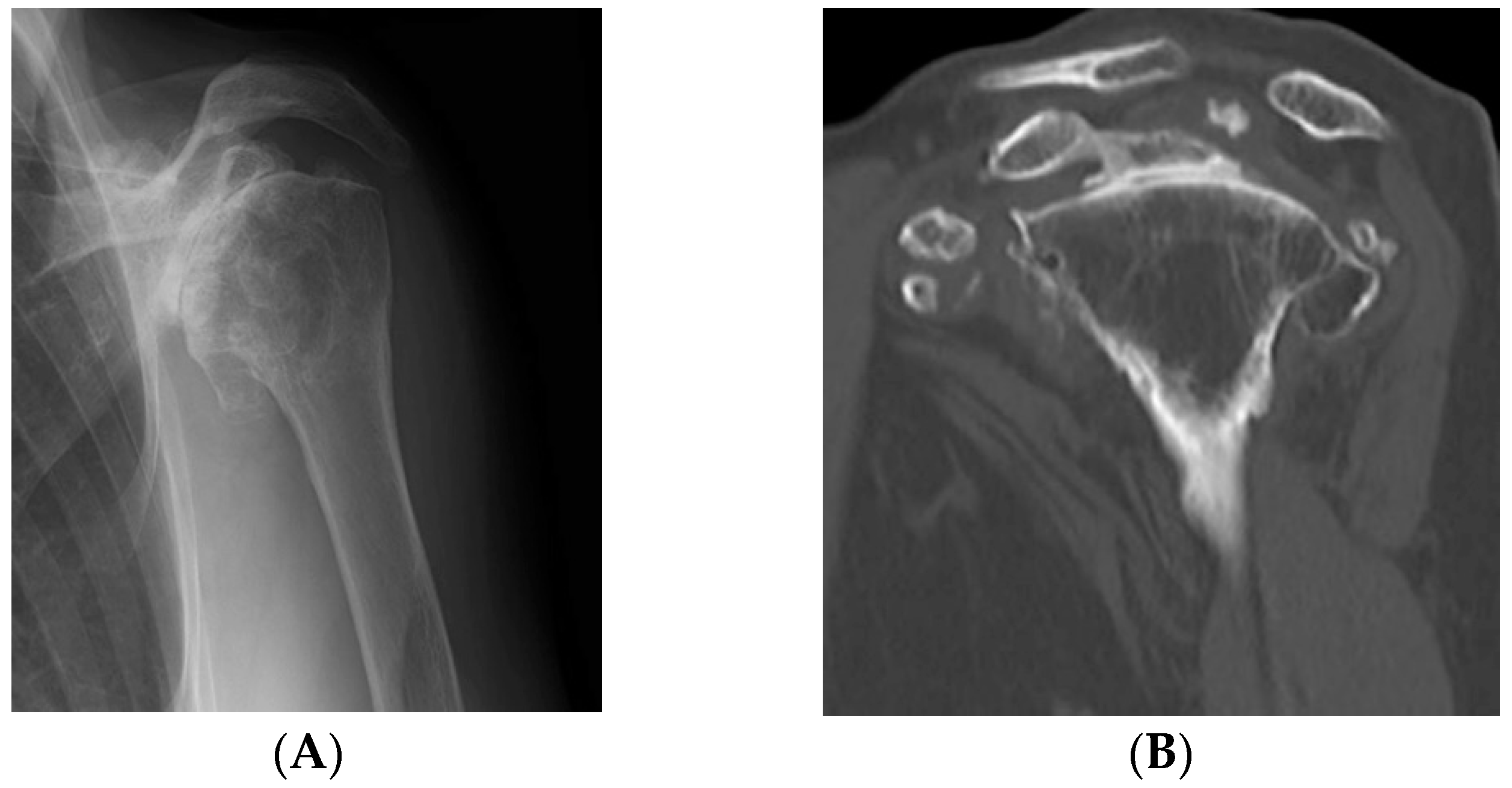 Reverse Shoulder Arthroplasty for Primary Synovial