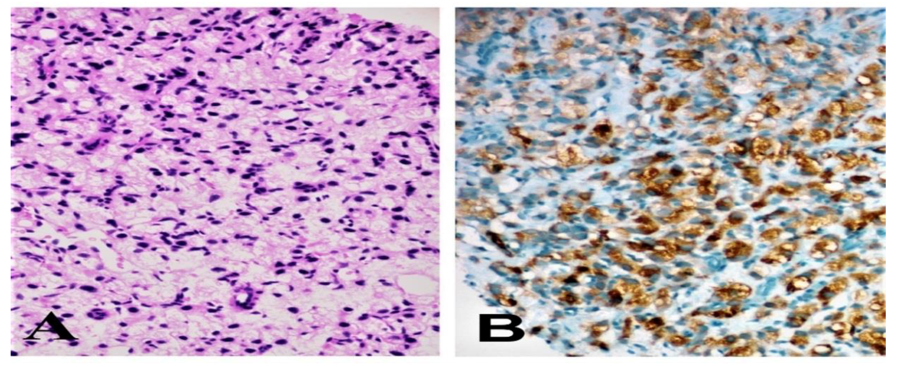 Qiao's Pathology: Signet-Ring Cell Variant of Invasive Lob… | Flickr