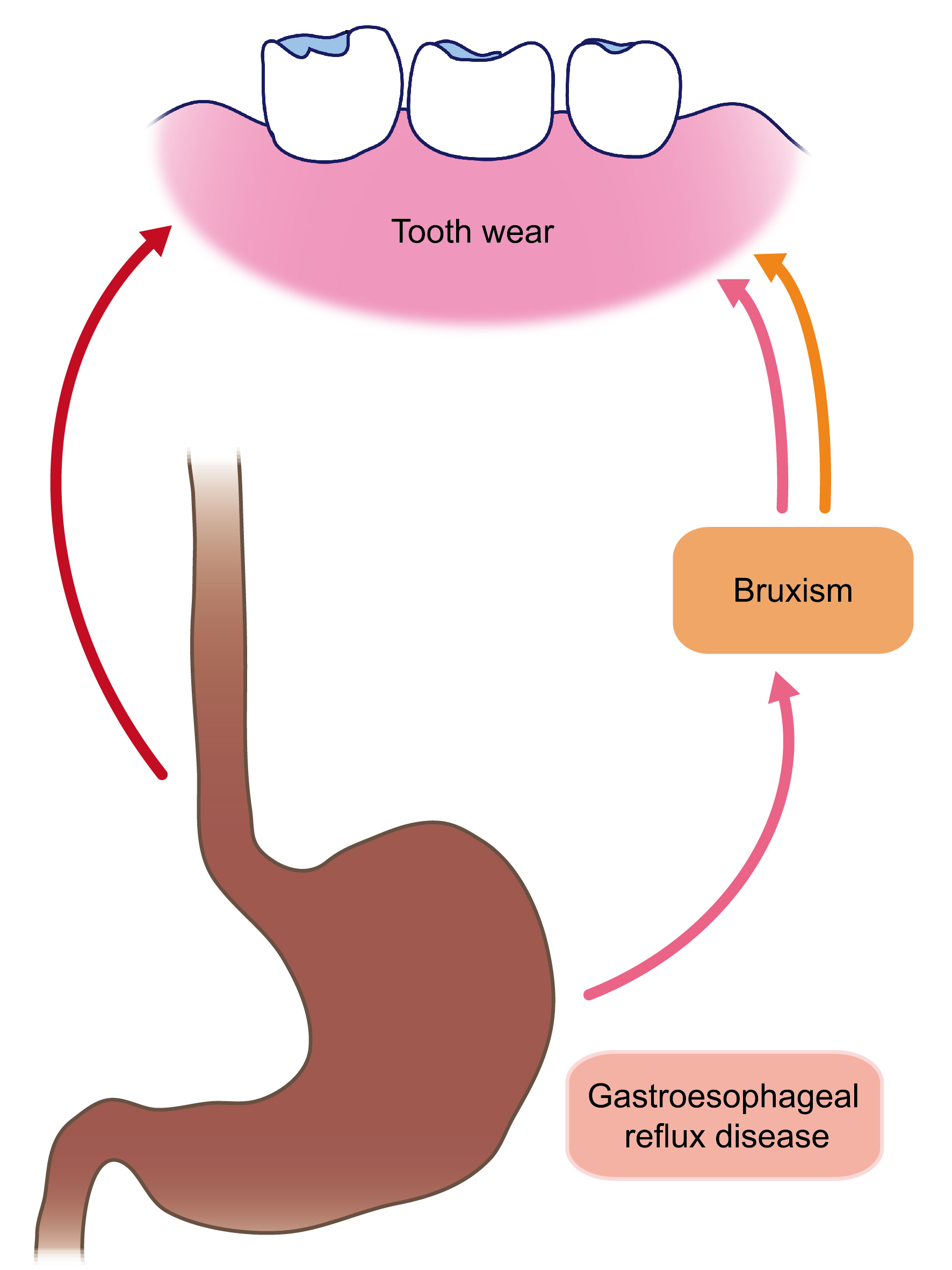 JCM Free FullText Associations among Bruxism, Gastroesophageal