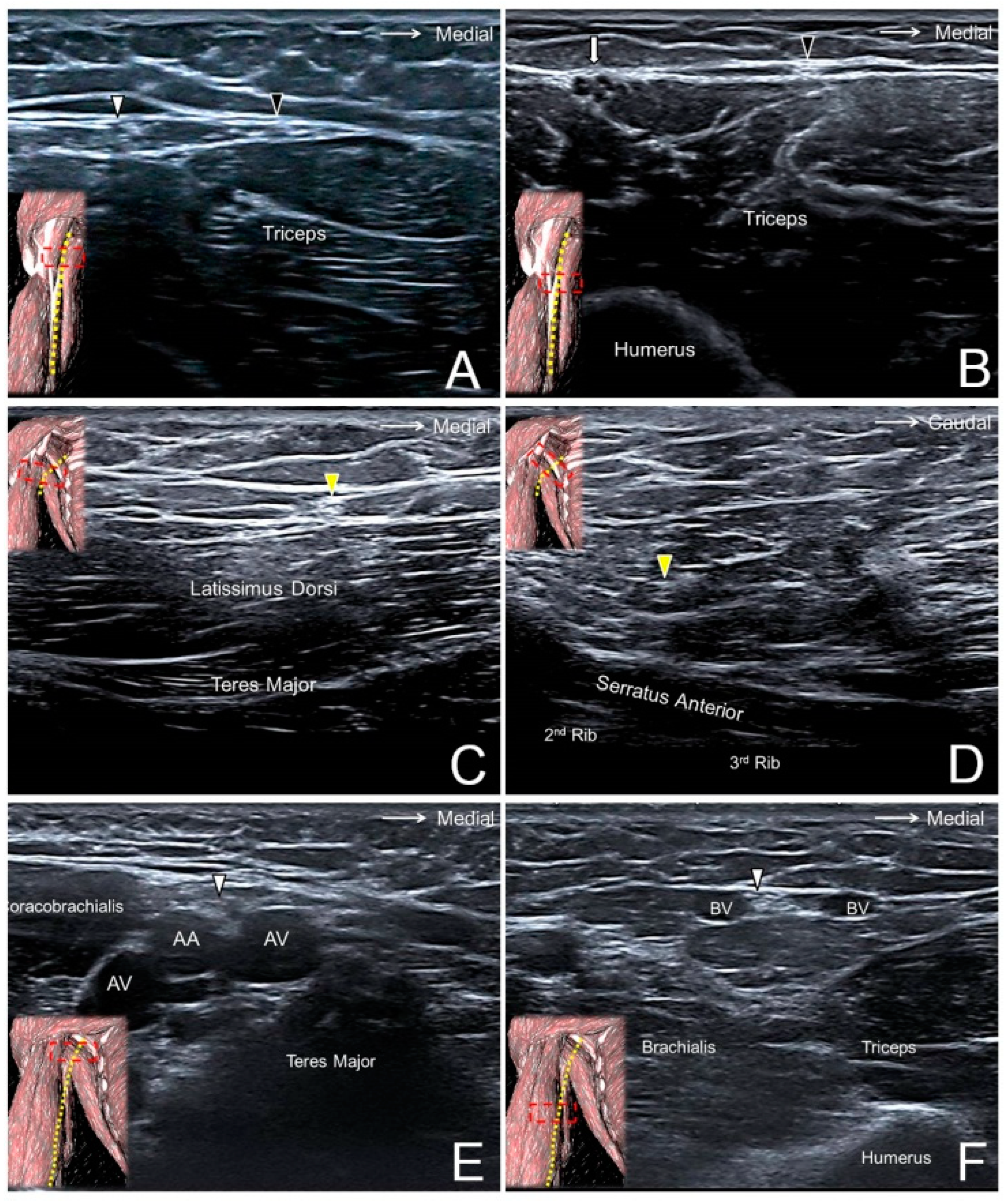 JCM | Free Full-Text | Ultrasound Imaging for the Cutaneous Nerves of