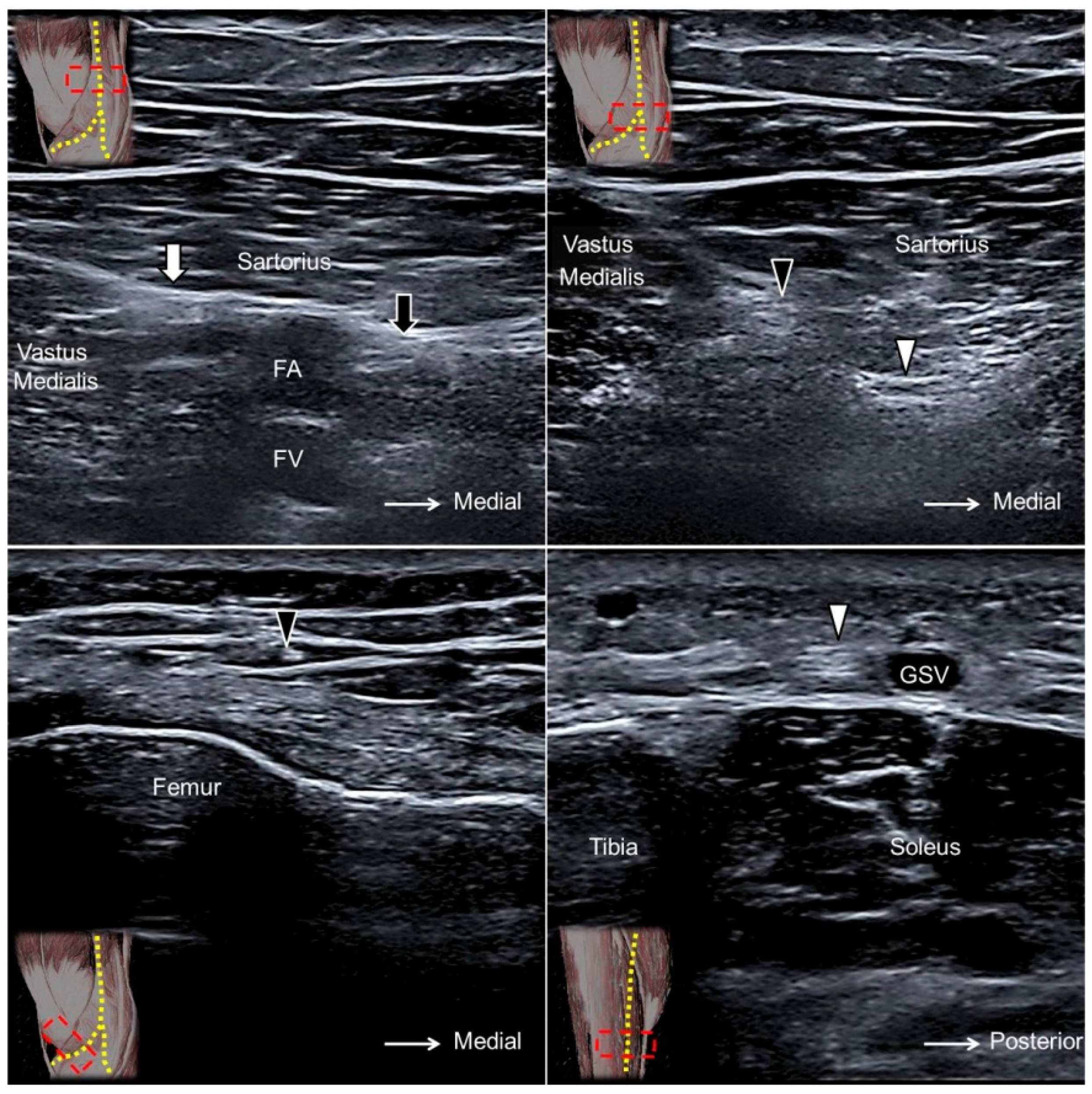 jcm free full text ultrasound imaging for the adductor canal