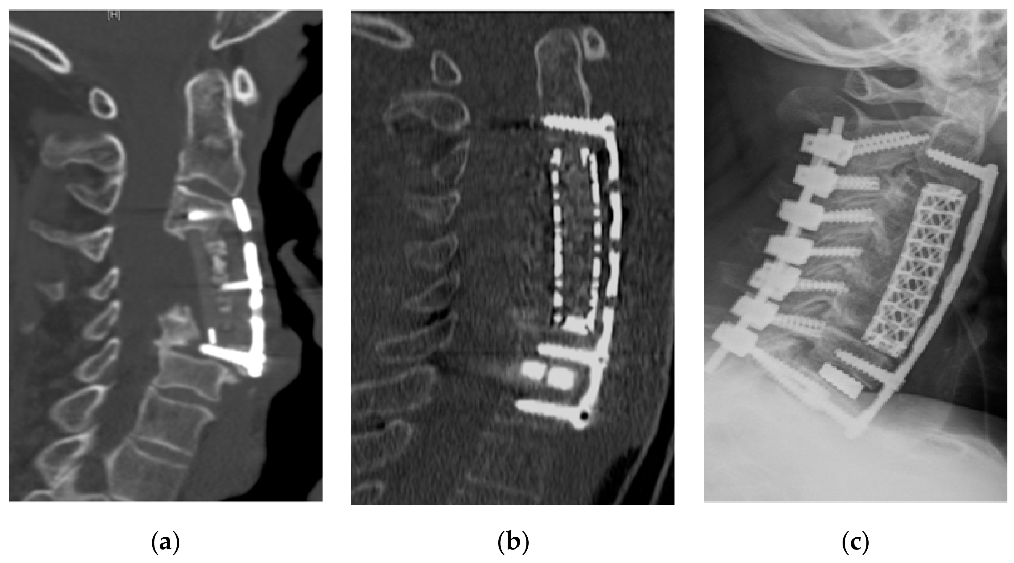 C3-4 and C4-5 discectomy