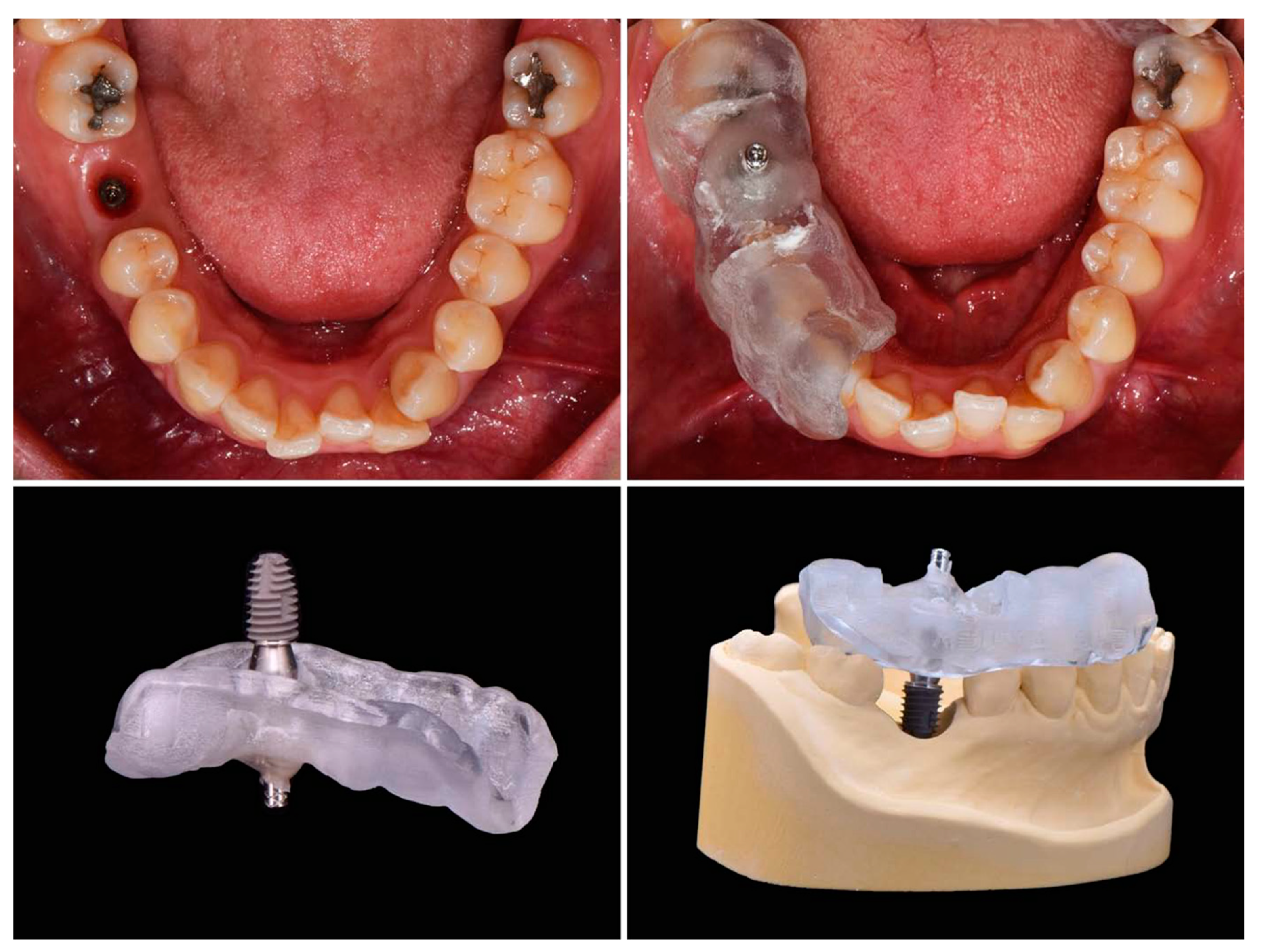 JCM Free FullText Methods Used to Assess the 3D Accuracy of Dental