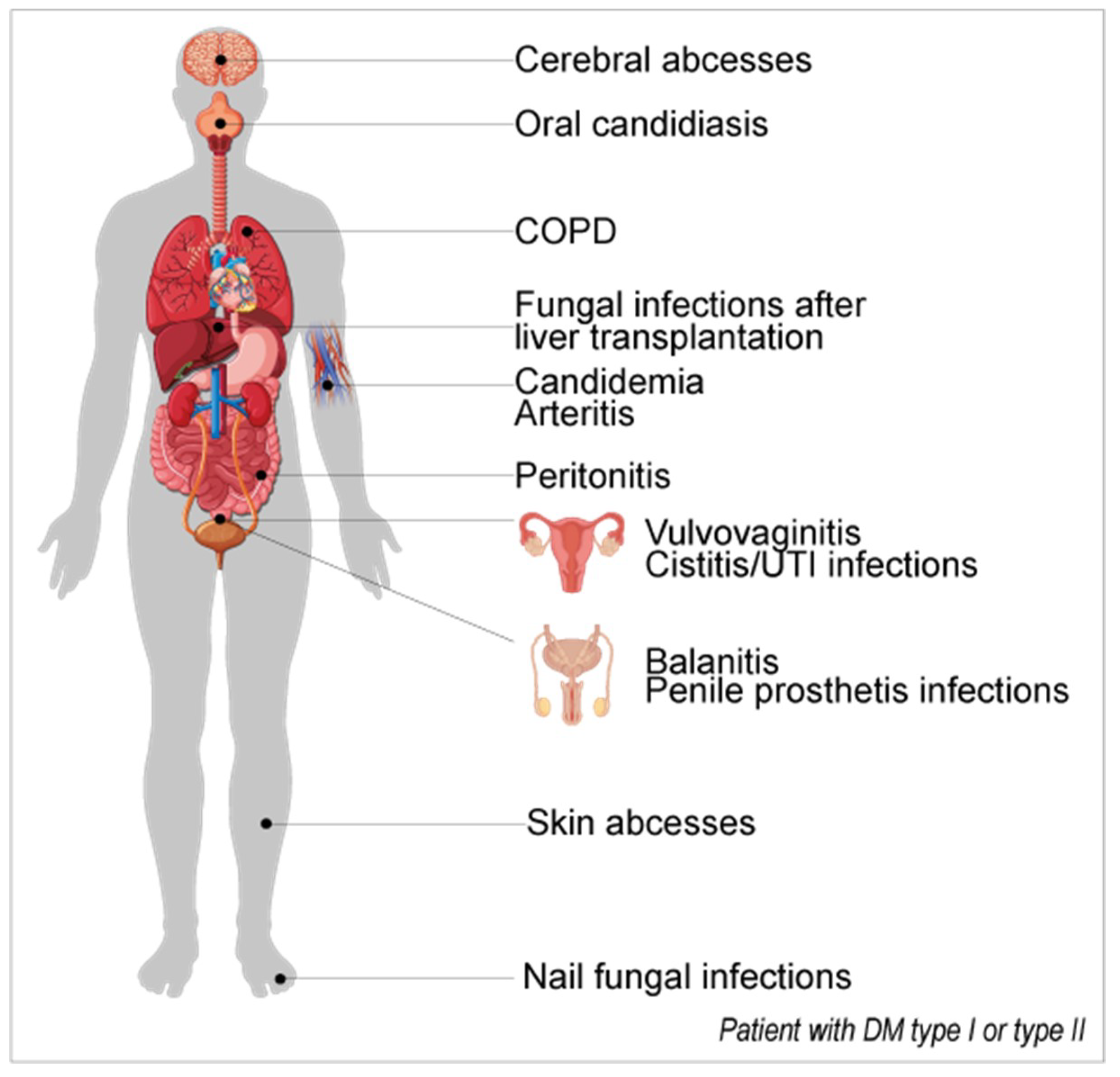 treatment of candida prostatitis capsula prostatica indemne