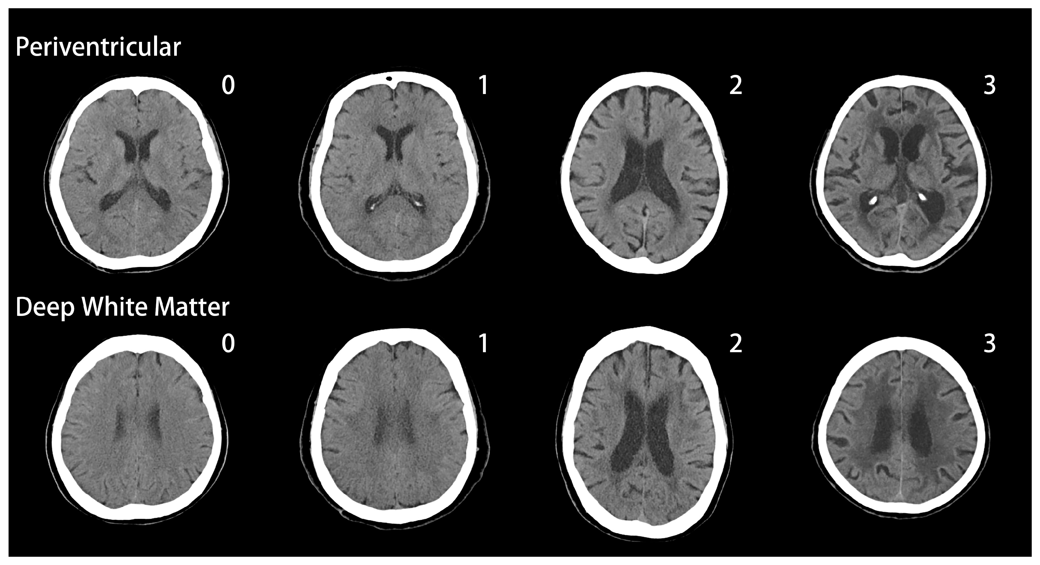 Микроангиопатия головного мозга fazekas. Шкала Fazekas. Periventricular. Шкала Фазекас мрт. Fazekas классификация.