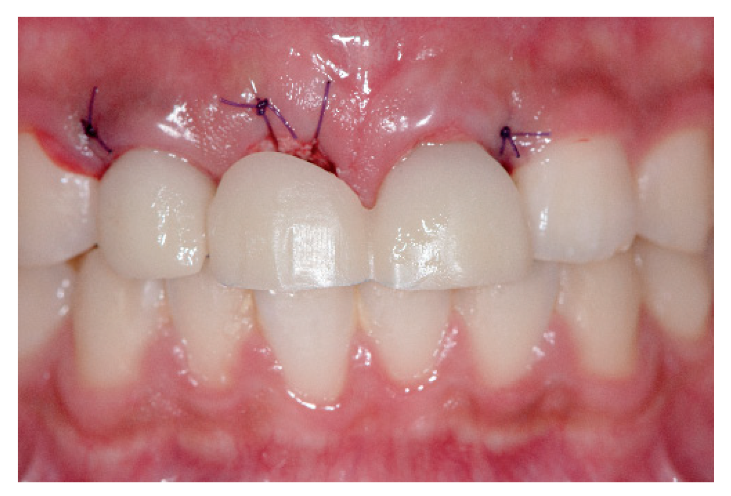 JCM Free FullText Esthetic Rehabilitation of Maxillary Anterior