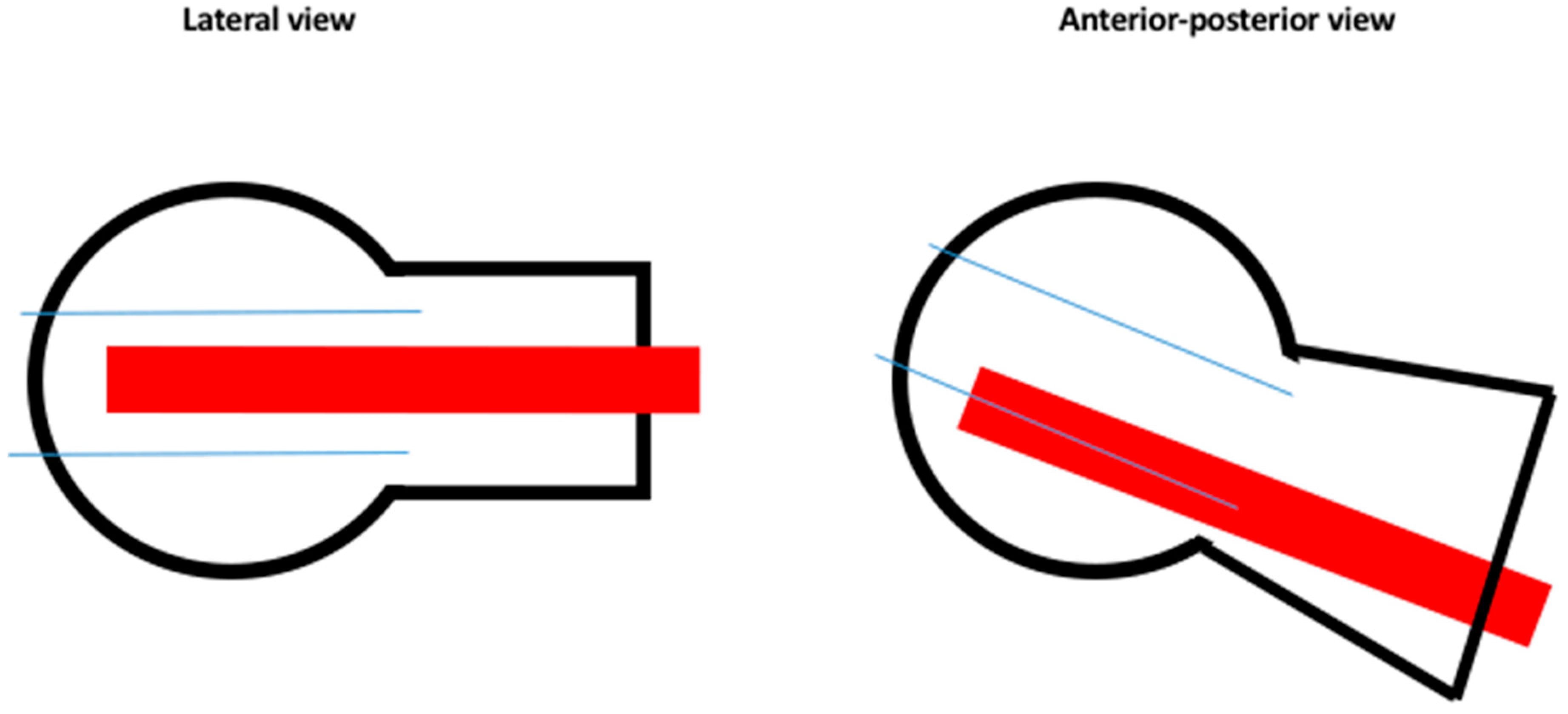 Comparison of clinical outcomes with InterTan vs Gamma nail or PFNA in the  treatment of intertrochanteric fractures A metaanalysis  Scientific  Reports