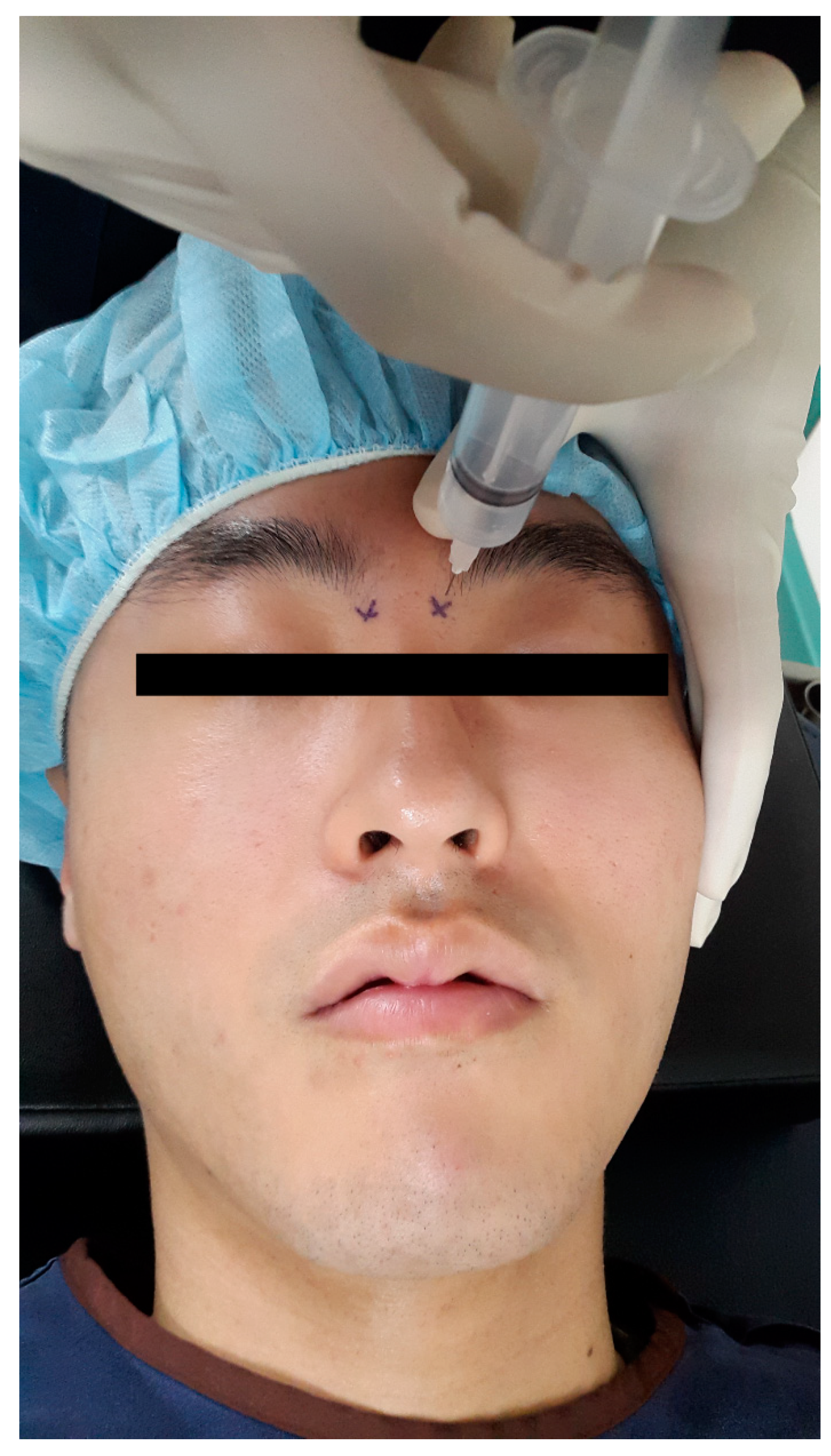 JCM | Free Full-Text | Effects of Bilateral Infraorbital and ...