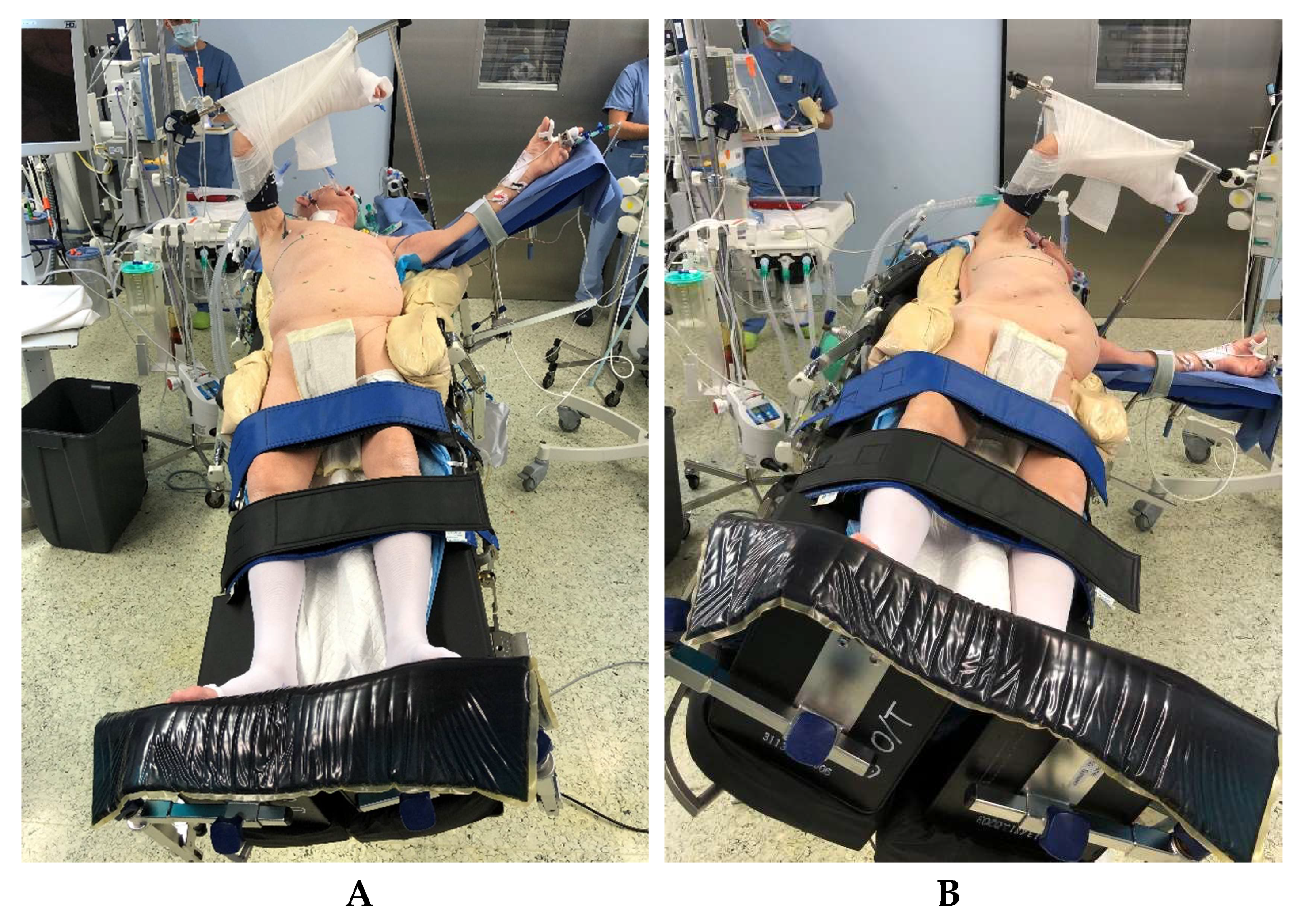 Jcm Free Full Text Hybrid Minimally Invasive Esophagectomy Surgical Technique And Results Html