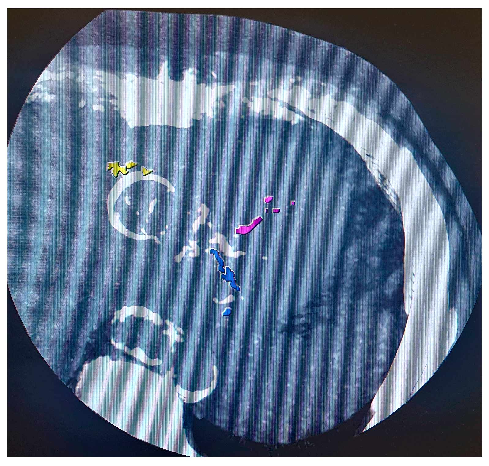 Jcm Free Full Text Subclinical Atherosclerosis Imaging In People Living With Hiv Html