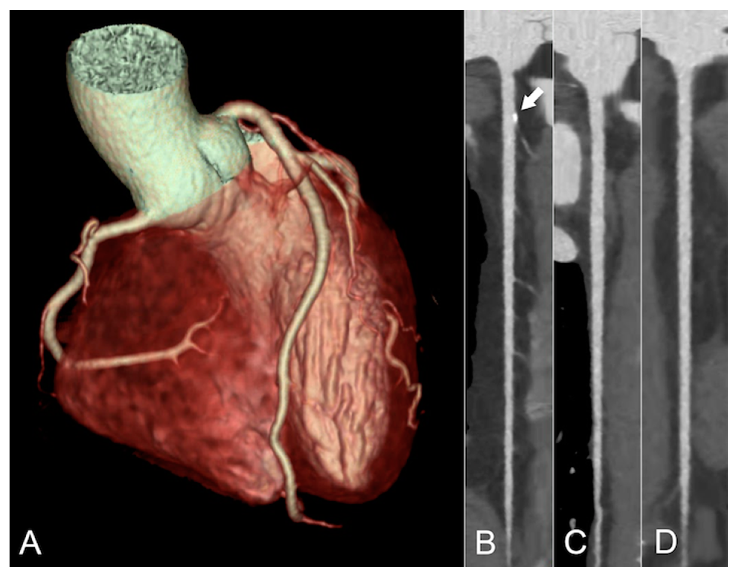 Jcm Free Full Text Subclinical Atherosclerosis Imaging In People Living With Hiv Html