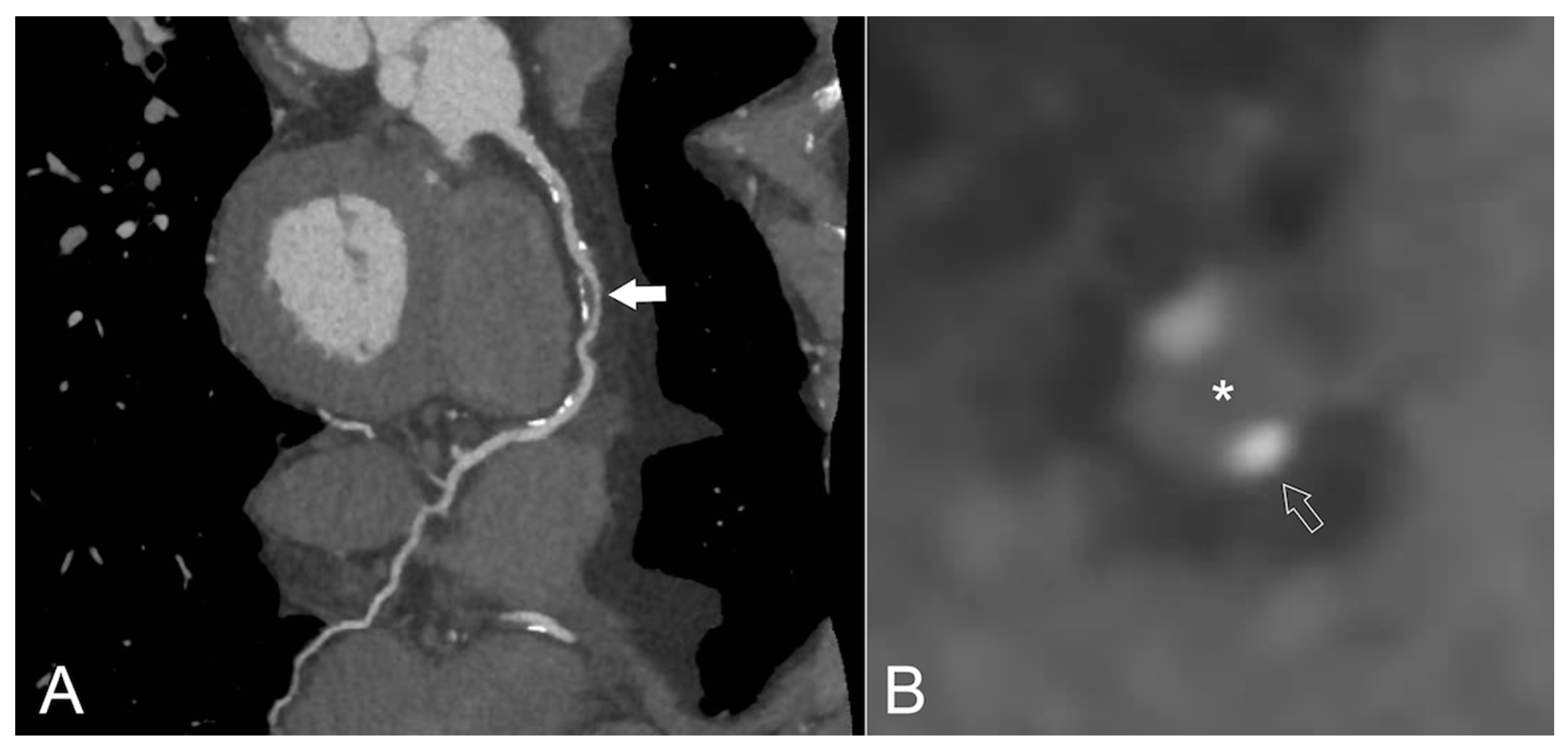 Jcm Free Full Text Subclinical Atherosclerosis Imaging In People Living With Hiv Html