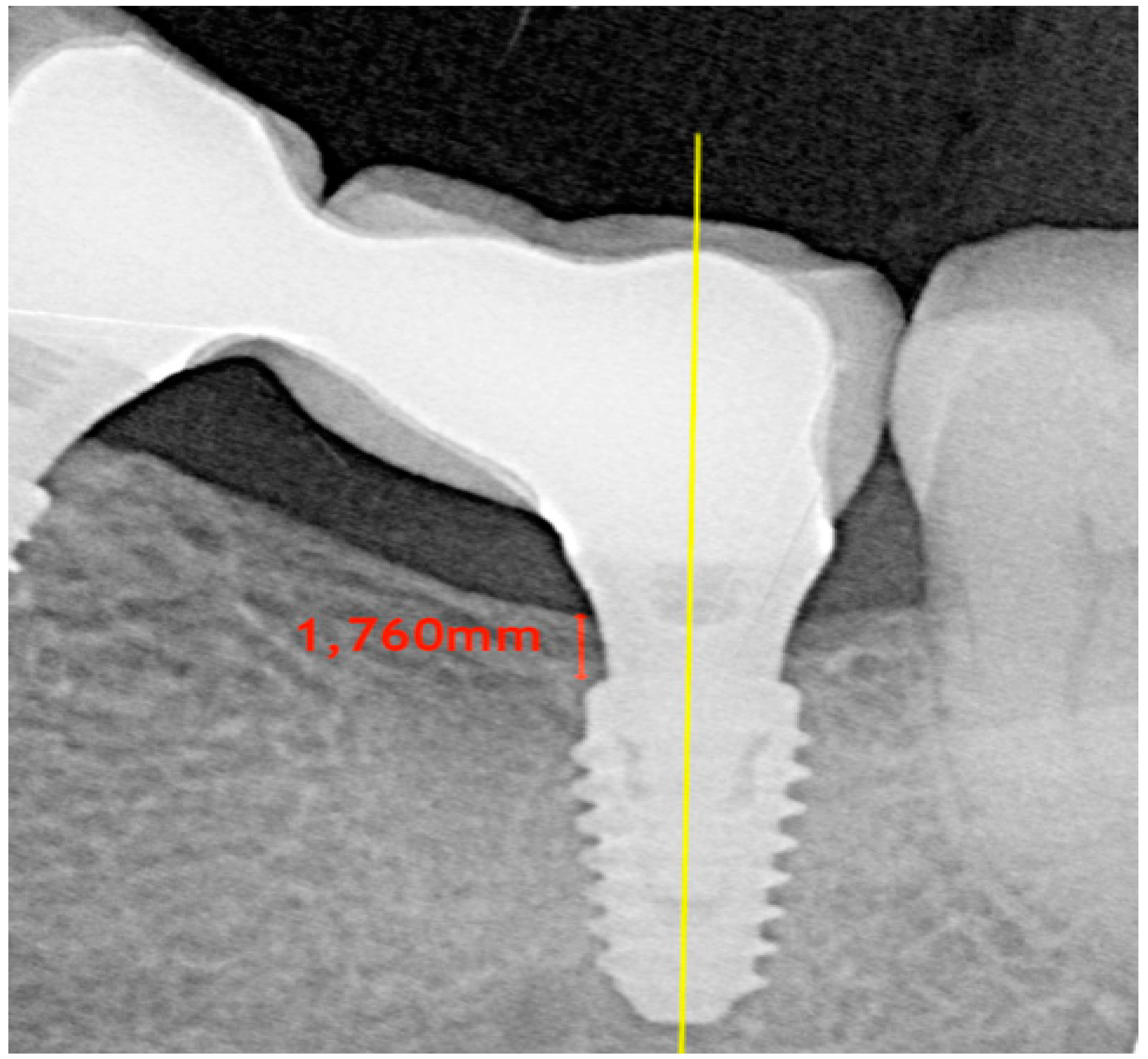 JCM Free FullText Factors Influencing Early Marginal Bone Loss