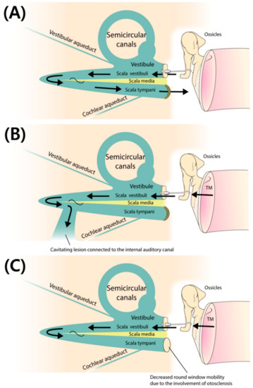 Otosclerosis, Otolaryngology⁠ — Head & Neck Surgery