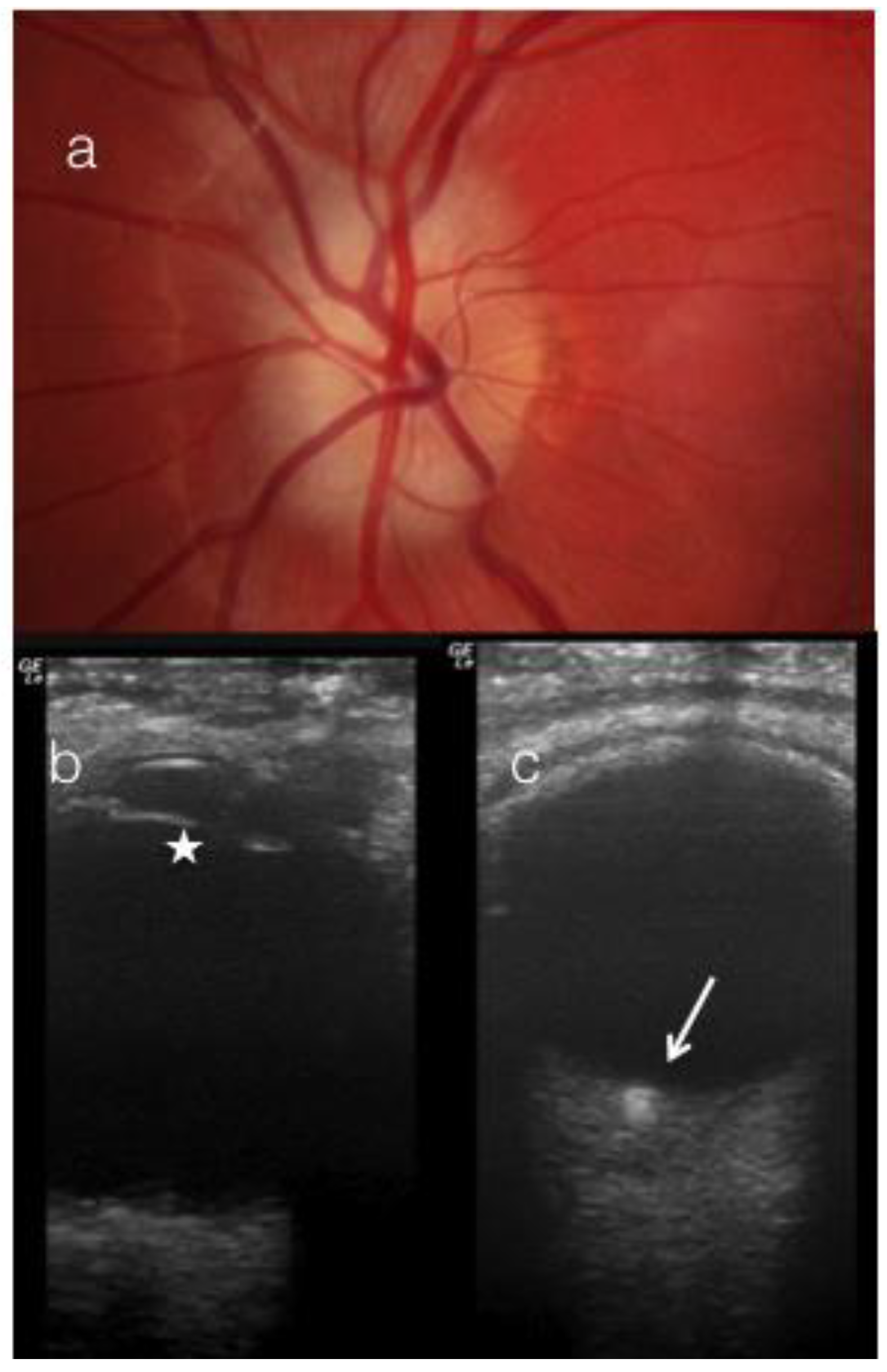 Buried Disc Drusen have hyporeflective appearance on SDOCT
