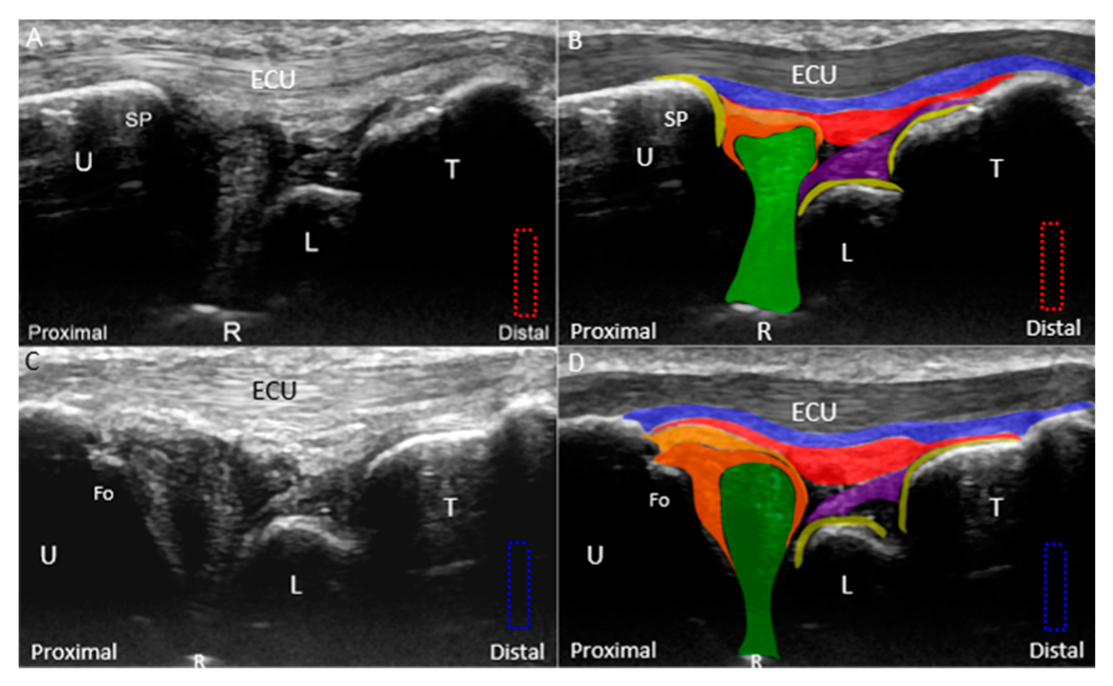 JCM | Free Full-Text | Ulnar Wrist Pain Revisited: Ultrasound Diagnosis
