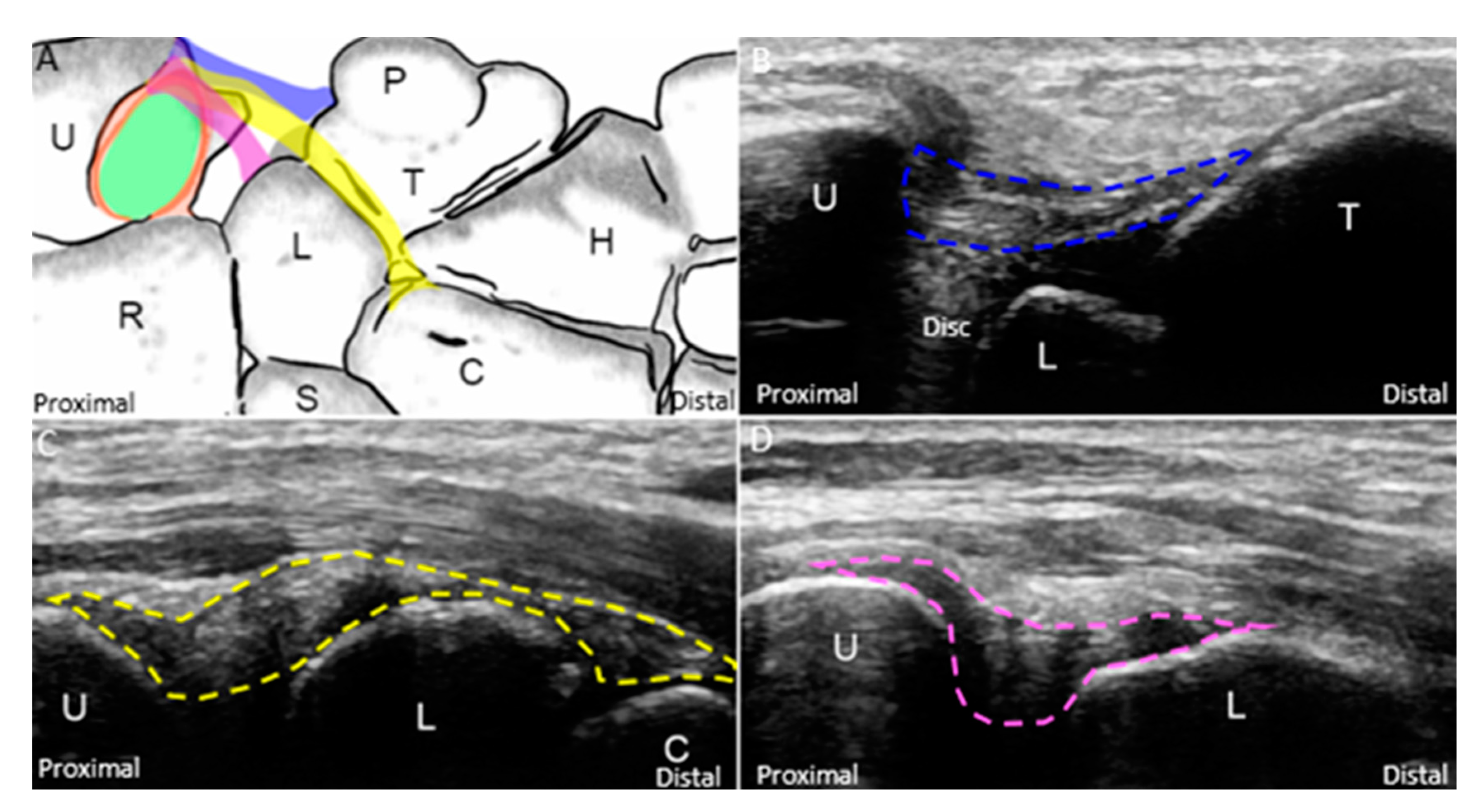 JCM Free FullText Ulnar Wrist Pain Revisited Ultrasound Diagnosis