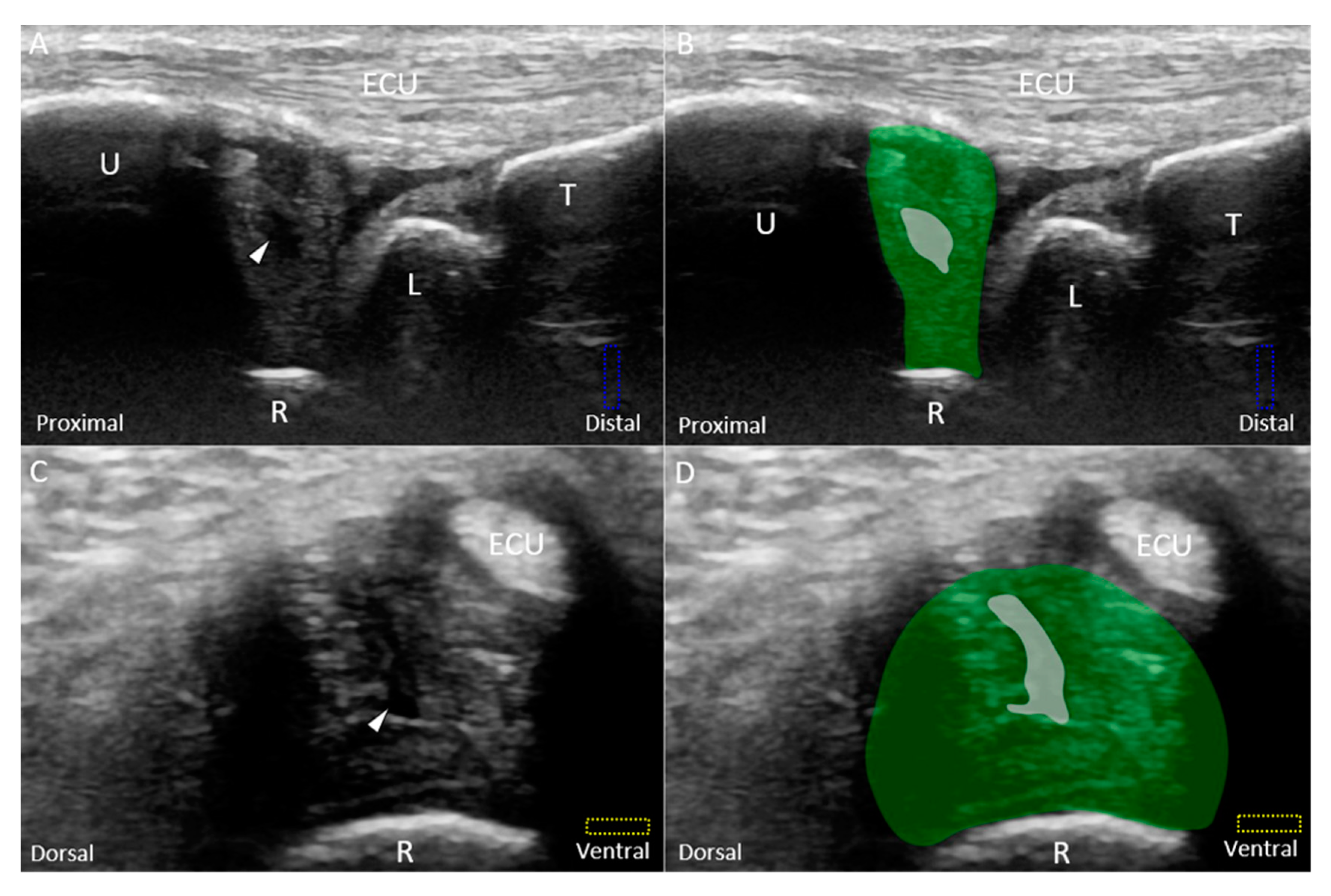 JCM | Free Full-Text | Ulnar Wrist Pain Revisited: Ultrasound Diagnosis