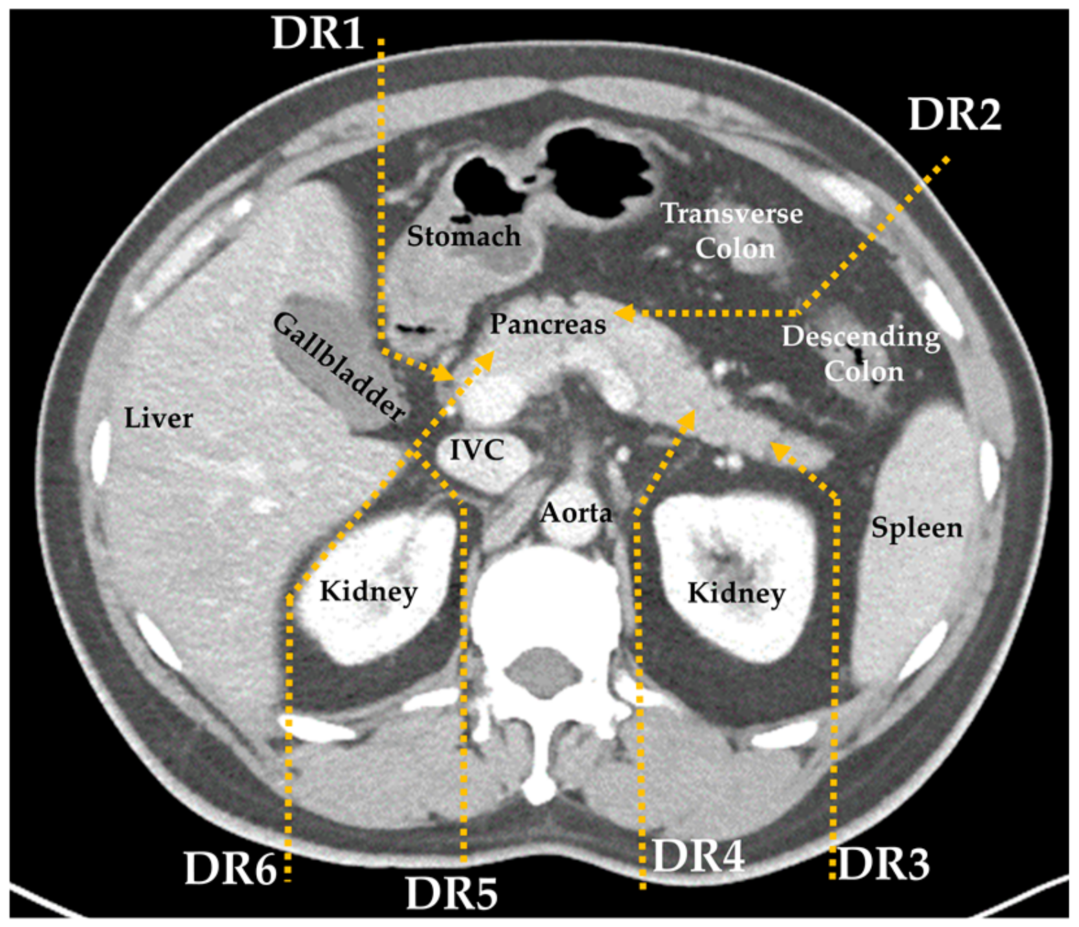 Normal Pancreas Cat Scan