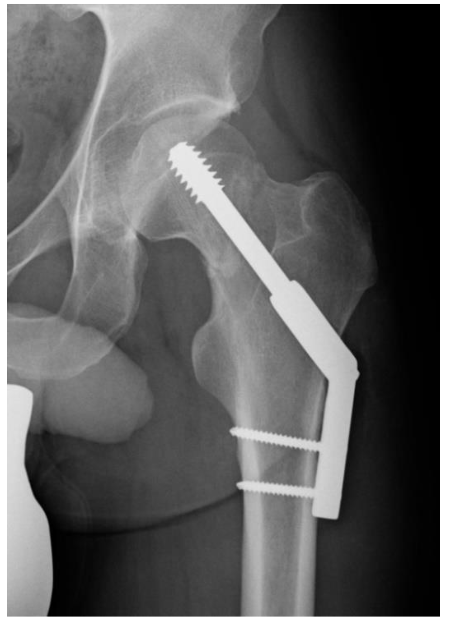 JCM | Free Full-Text | A Comparison of Dynamic Hip Screw and Two Cannulated  Screws in the Treatment of Undisplaced Intracapsular Neck  Fractures—Two-Year Follow-Up of 453 Patients