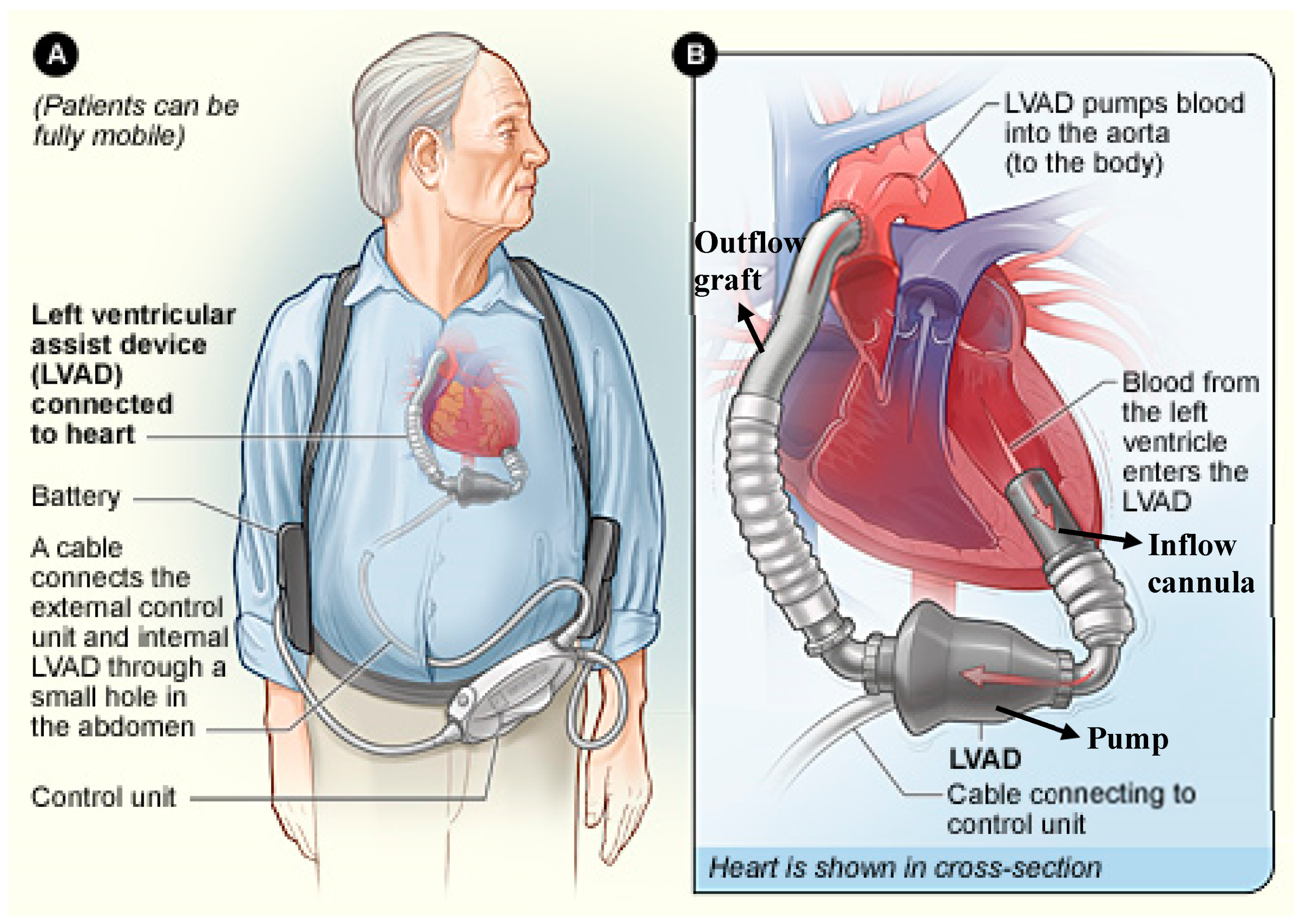 Left Ventricular Dysfunction — TPA