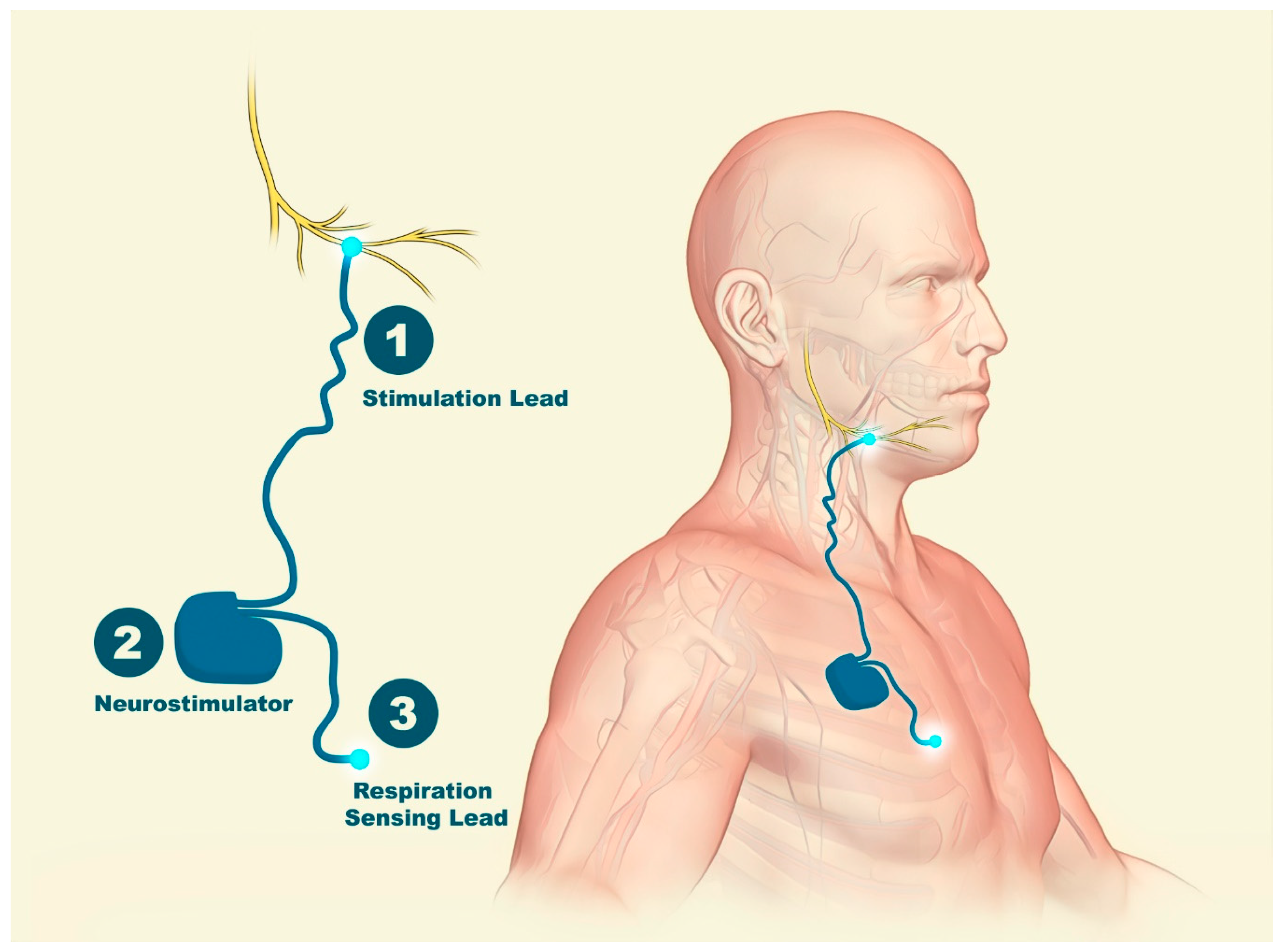 nerve stimulator implant nerve stimulator implant
